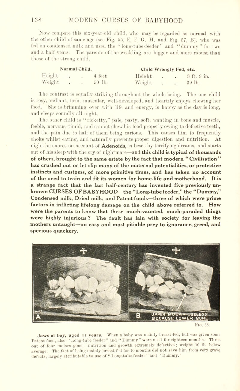 Now compare this six-year-old child, who may be regarded as normal, with the other child of same age (see Fig. f>5, E, F, G, II, and Fig. 57, B), who was fed on condensed milk and used the “long-tube-feeder” and “dummy” for two and a half years. The parents of the weakling are bigger and more robust than those of the strong child. Normal Child. Child Wrongly Fed, etc. Height . . 4 feet Height , . 3 ft. 9 in. \\ eight . . 50 lb. Weight . . 39 lb. The contrast is equally striking throughout the whole being. The one child is rosy, radiant, firm, muscular, well-developed, and heartily enjoys chewing her food. She is brimming over with life and energy, is happy as the day is long, and sleeps soundly all night. The other child is “ricketty, ” pale, pasty, soft, wanting in bone and muscle, feeble, nervous, timid, and cannot chew his food properly owing to defective teeth, and the pain due to half of them being carious. This causes him to frequently choke whilst eating, and naturally prevents proper digestion and nutrition. At night he snores on account of Adenoids, is beset by terrifying dreams, and starts out of his sleep with the cry of nightmare—and this child is typical of thousands of others, brought to the same estate by the fact that modern “Civilisation ” has crushed out or let slip many of the maternal potentialities, or protective instincts and customs, of more primitive times, and has taken no account of the need to train and fit its women for home-life and motherhood. It is a strange fact that the last half-century has invented five previously un¬ known CURSES OF BABYHOOD—the “Long-tubefeeder,” the “Dummy,” Condensed milk, Dried milk, and Patent foods—three of which were prime factors in inflicting lifelong damage on the child above referred to. How were the parents to know that these much-vaunted, much-paraded things were highly injurious ? The fault has lain with society for leaving the mothers untaught—an easy and most pitiable prey to ignorance, greed, and specious quackery. Flo. 5S. Jaws of boy, aged i i years. When a baby was mainly breast-fed, but was given some Patent food, also “ Long-tube feeder” and “ Dummy” were used for eighteen months. Three out of four molars gone; nutrition and growth extremely defective ; weight 10 lb. below average. The fact of being mainly breast-fed for 10 months did not save him from very grave defects, largely attributable to use of “ Long-tube feeder  and “ Dummy.