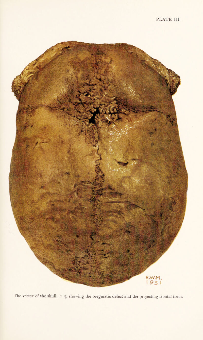 The vertex of the skull, x f, showing the bregmatic defect and the projecting frontal torus