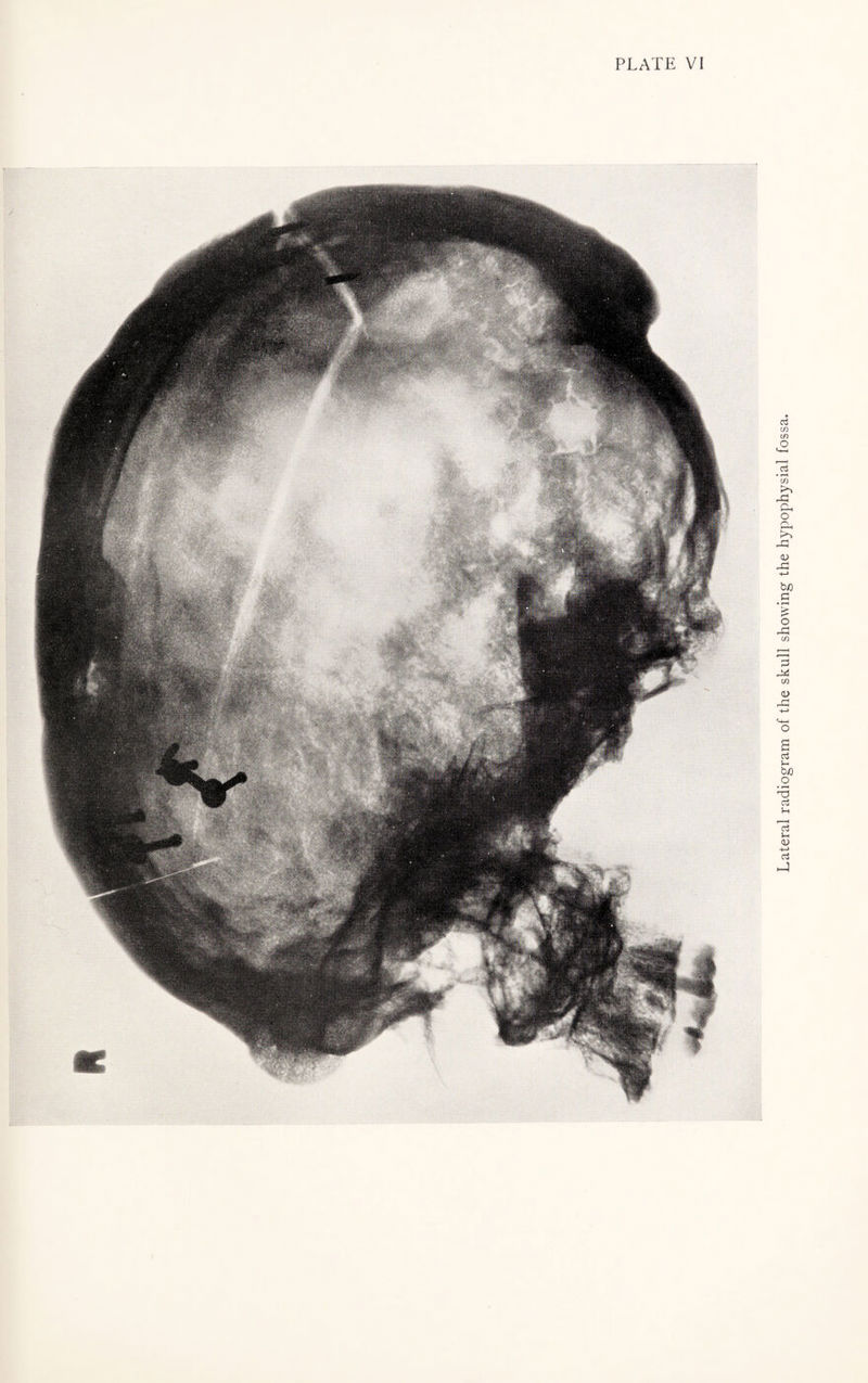 Lateral radiogram of the skull showing the hypophysial fossa.