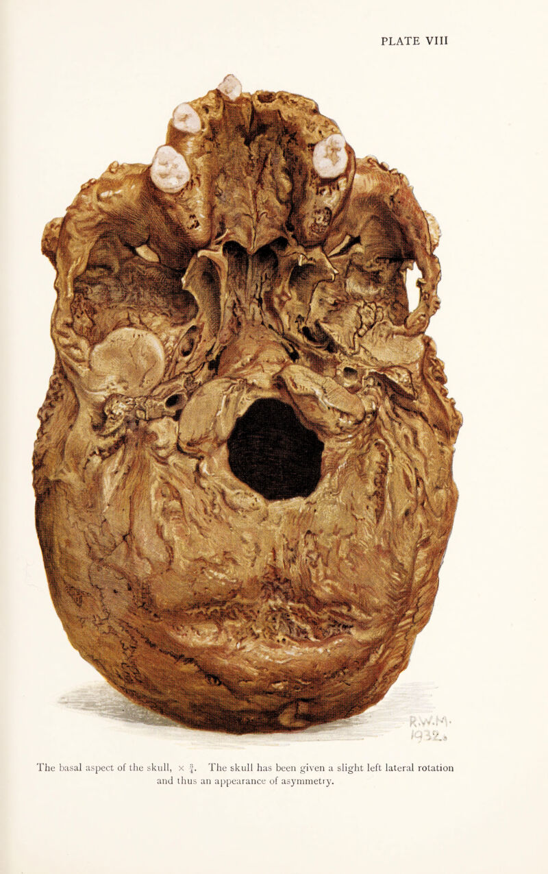The basal aspect of the skull, x 4* The skull has been erven a slight left lateral rotation and thus an appearance of asymmetry.