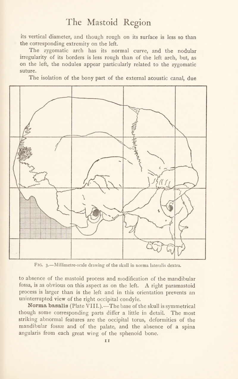 The Mastoid Region its vertical diameter, and though rough on its surface is less so than the corresponding extremity on the left. The zygomatic arch has its normal curve, and the nodular irregularity of its borders is less rough than of the left arch, but, as on the left, the nodules appear particularly related to the zygomatic suture. The isolation of the bony part of the external acoustic canal, due Fig. 3.—Millimetre-scale drawing of the skull in norma lateralis dextra. to absence of the mastoid process and modification of the mandibular fossa, is as obvious on this aspect as on the left. A right paramastoid process is larger than is the left and in this orientation prevents an uninterrupted view of the right occipital condyle. Norma basalis (Plate VIII.).—The base of the skull is symmetrical though some corresponding parts differ a little in detail. The most striking abnormal features are the occipital torus, deformities of the mandibular fossae and of the palate, and the absence of a spina angularis from each great wing of the sphenoid bone.