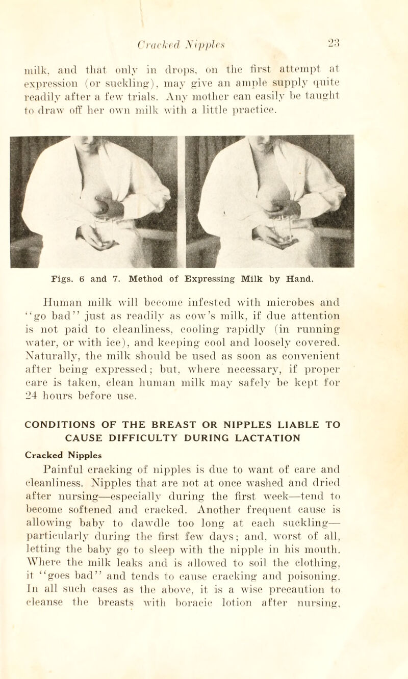 Crack(d Mipplrs 24 milk, and that only in drops, on the first attempt at expression (or suckling), may give an ample supply quite readily after a few trials. Any mother can easily he taught to draw off her own milk with a little practice. Figs. 6 and 7. Method of Expressing Milk by Hand. Human milk will become infested with microbes and “go bad” just as readily as cow’s milk, if due attention is not paid to cleanliness, cooling rapidly (in running water, or with ice), and keeping cool and loosely covered. Naturally, the milk should be used as soon as convenient after being expressed; but. where necessary, if proper care is taken, clean human milk may safely be kept for 24 hours before use. CONDITIONS OF THE BREAST OR NIPPLES LIABLE TO CAUSE DIFFICULTY DURING LACTATION Cracked Nipples Painful cracking of nipples is due to want of care and cleanliness. Nipples that are not at once washed and dried after nursing—especially during the first week—tend to become softened and cracked. Another frequent cause is allowing baby to dawdle too long at each suckling— particularly during the first few days; and, worst of all, letting the baby go to sleep with the nipple in his mouth. Where the milk leaks and is allowed to soil the clothing, it “goes bad” and tends to cause cracking and poisoning. In all such eases as the above, it is a wise precaution to cleanse the breasts with borac-ic lotion after nursing,