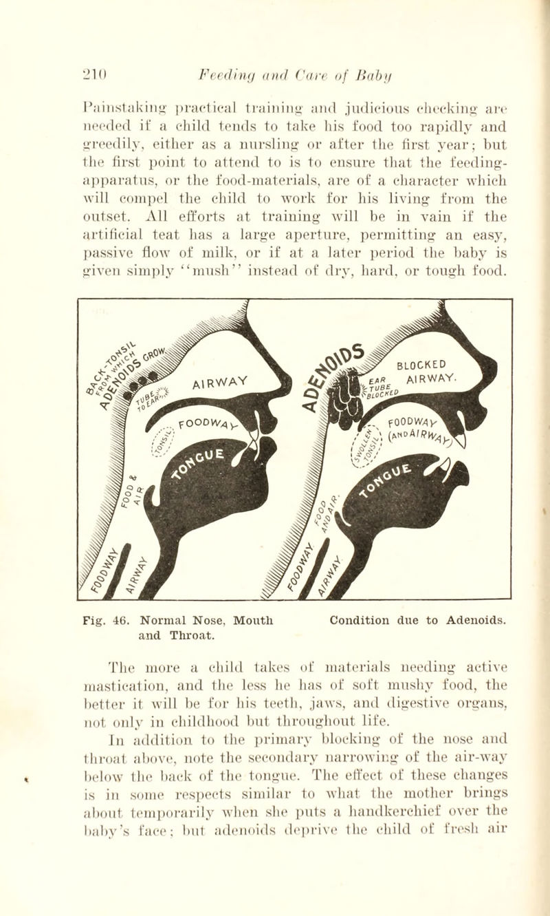 Painstaking practical training and judicious checking are needed if a child tends to take his food too rapidly and greedily, either as a nursling or after the first year; but the first point to attend to is to ensure that the feeding- apparatus, or the food-materials, are of a character which will compel the child to work for his living from the outset. All efforts at training will be in vain if the artificial teat has a large aperture, permitting an easy, passive flow of milk, or if at a later period the baby is given simply “mush” instead of dry, hard, or tough food. Fig. 46. Normal Nose, Mouth Condition due to Adenoids, and Throat. The more a child takes of materials needing active mastication, and the less he has of soft mushy food, the better it will be for his teeth, jaws, and digestive organs, not only in childhood but throughout life. In addition to the primary blocking of the nose and throat above, note the secondary narrowing of the air-way below the back of the tongue. The effect of these changes is in some respects similar to what the mother brings about temporarily when she puts a handkerchief over the baby’s face; but adenoids deprive the child of fresh air