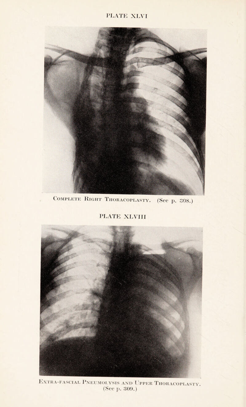 Complete Right Thoracoplasty. (See p. SOS.)