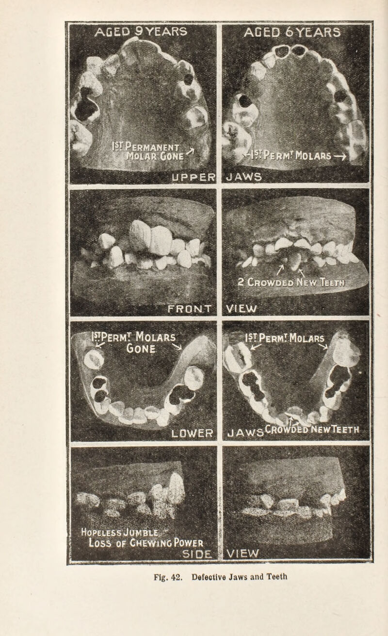 ERMANENT |OMft;G0HE FPermT Molars ^ Gone 'h IIT Perm! Molars j A w S LOWER