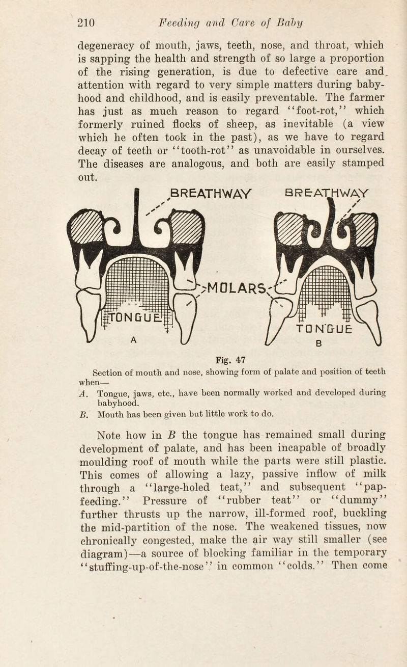degeneracy of month, jaws, teeth, nose, and throat, which is sapping the health and strength of so large a proportion of the rising generation, is due to defective care and attention with regard to very simple matters during baby¬ hood and childhood, and is easily preventable. The farmer has just as much reason to regard “foot-rot,” which formerly ruined flocks of sheep, as inevitable (a view which he often took in the past), as we have to regard decay of teeth or “tooth-rot” as unavoidable in ourselves. The diseases are analogous, and both are easily stamped out. Fig. 47 Section of month and nose, showing form of palate and position of teeth when— A. Tongue, jaws, etc., have been normally worked and developed during babyhood. B. Mouth has been given but little work to do. Note how in B the tongue has remained small during development of palate, and has been incapable of broadly moulding roof of mouth while the parts were still plastic. This comes of allowing a lazy, passive inflow of milk through a “large-holed teat,” and subsequent “pap- feeding.” Pressure of “rubber teat” or “dummy” further thrusts up the narrow, ill-formed roof, buckling the mid-partition of the nose. The weakened tissues, now chronically congested, make the air way still smaller (see diagram)—a source of blocking familiar in tlie temporary “stuflPing-up-of-the-nose” in common “colds.” Then come
