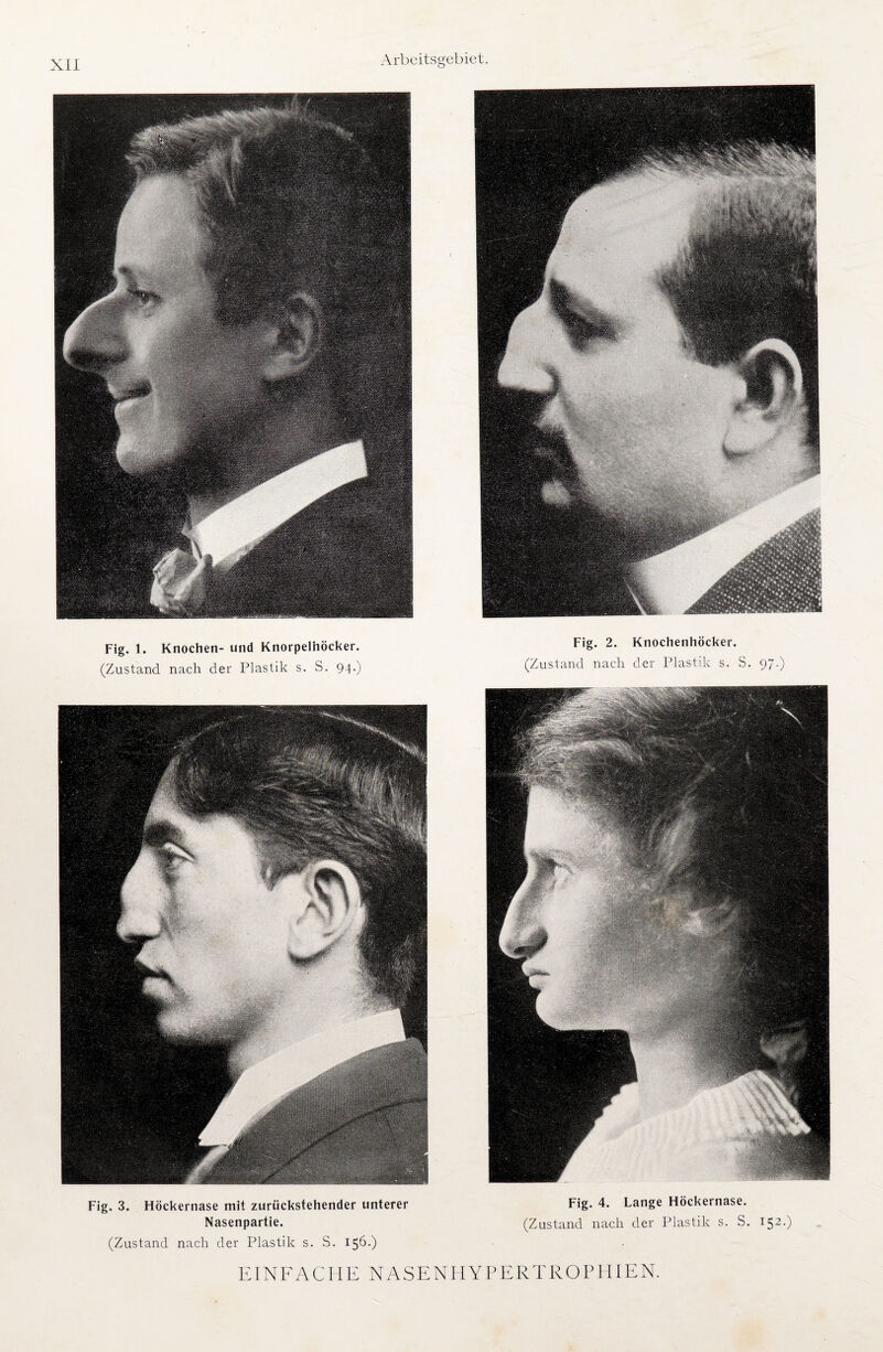 Fig. 1. Knochen- und Knorpelhöcker. (Zustand nach der Plastik s. S. 94.) Fig. 2. Knochenhöcker. (Zustand nach der Plastik s. S. 97.) Fig. 3. Höckernase mit zurückstehender unterer Nasenpartie. (Zustand nach der Plastik s. S. 156-) Fig. 4. Lange Höckernase. (Zustand nach der Plastik s. S. I52-) EINFACHE NASENHYPERTROPHIEN.