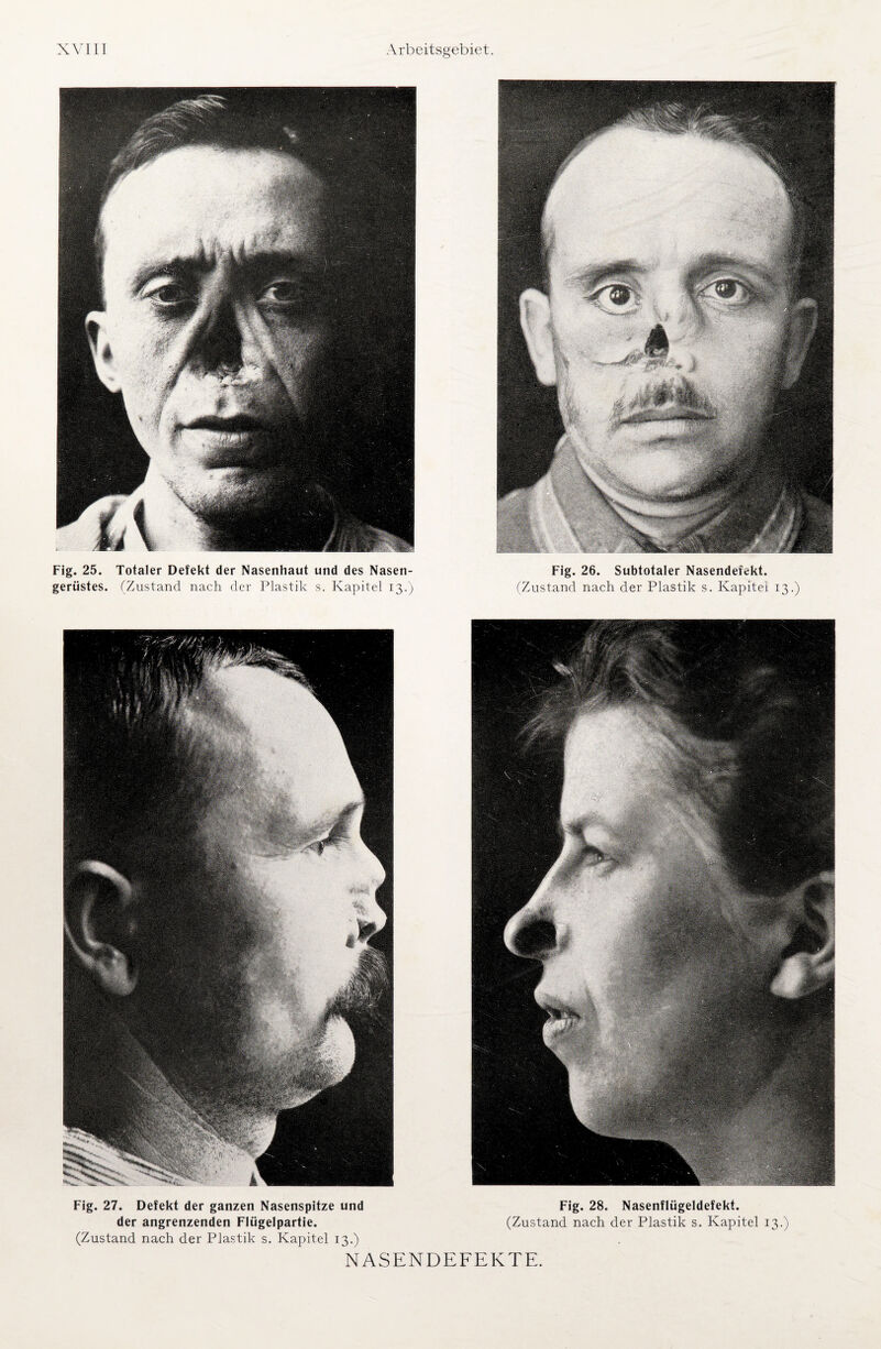 Fig. 25. Totaler Defekt der Nasenhaut und des Nasen¬ gerüstes. (Zustand nach der Plastik s. Kapitel 13.) Fig. 26. Subtotaler Nasendeiekt. (Zustand nach der Plastik s. Kapitel 13.) ■ 1 Fig. 27. Defekt der ganzen Nasenspitze und Fig. 28. Nasenflügeldefekt. der angrenzenden Flügelpartie. (Zustand nach der Plastik s. Kapitel 13.) (Zustand nach der Plastik s. Kapitel 13.)
