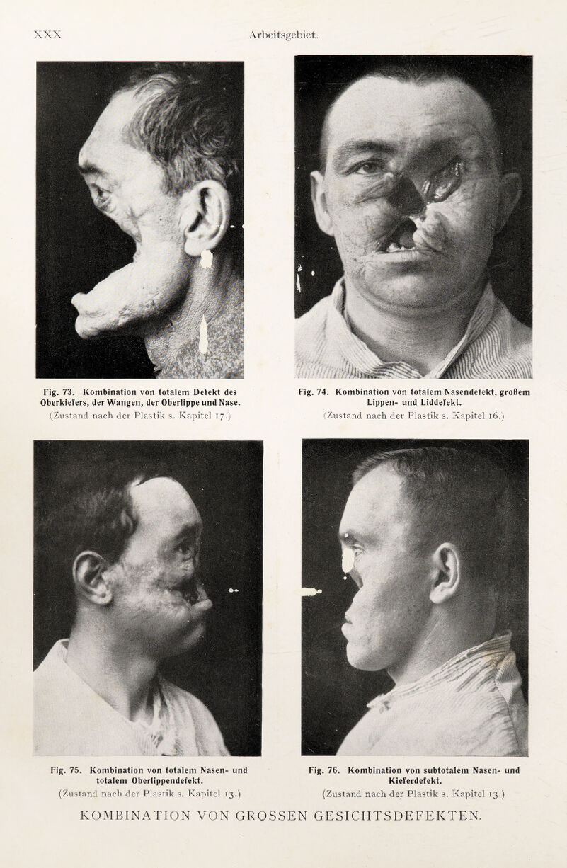 Fig. 73. Kombination von totalem Defekt des Oberkiefers, der Wangen, der Oberlippe und Nase. (Zustand nach der Plastik s. Kapitel 17.) Fig. 74. Kombination von totalem Nasendefekt, großem Lippen- und Liddefekt. (Zustand nach der Plastik s. Kapitel 16.) Fig. 75. Kombination von totalem Nasen- und totalem Oberlippendefekt. (Zustand nach der Plastik s. Kapitel 13.) Fig. 76. Kombination von subtotalem Nasen- und Kieferdefekt. (Zustand nach der Plastik s. Kapitel 13.) KOMBINATION VON GROSSEN GESICHTSDEFEKTEN.