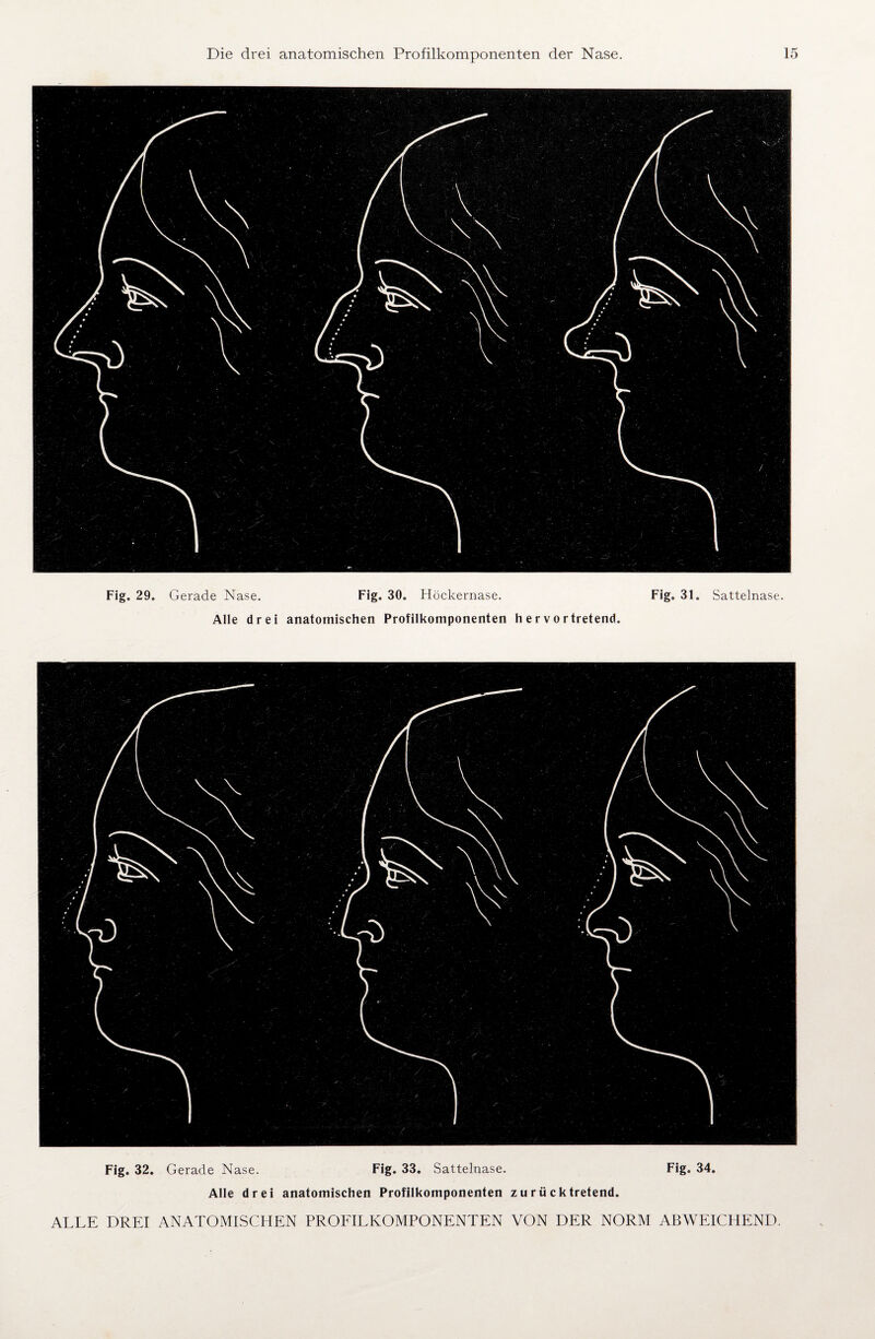 Fig. 29, Gerade Nase. Fig. 30. Höckernase. Fig, 31. Sattelnase. Alle drei anatomischen Profilkomponenten hervortretend. Fig. 32. Gerade Nase. Fig. 33. Sattelnase. Fig, 34. Alle drei anatomischen Profilkomponenten zu rück tretend.