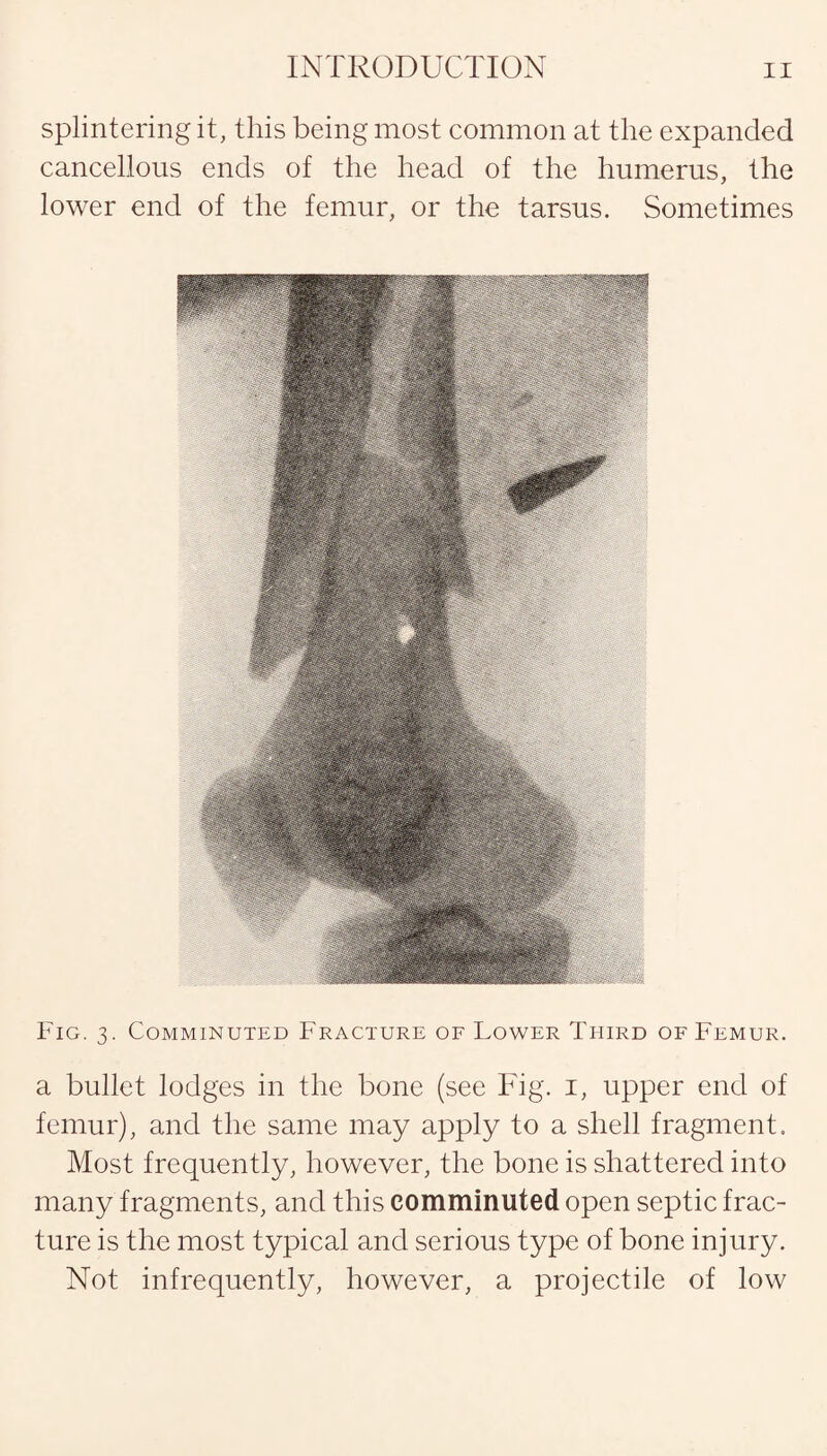splintering it, this being most common at the expanded cancellous ends of the head of the humerus, the lower end of the femur, or the tarsus. Sometimes Fig. 3. Comminuted Fracture of Lower Third of Femur. a bullet lodges in the bone (see Fig. 1, upper end of femur), and the same may apply to a shell fragment. Most frequently, however, the bone is shattered into many fragments, and this comminuted open septic frac¬ ture is the most typical and serious type of bone injury. Not infrequently, however, a projectile of low