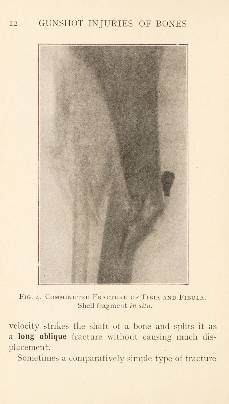Fig. 4. Comminuted Fracture of Tibia and Fibula. Shell fragment in situ. velocity strikes the shaft of a bone and splits it as a long oblique fracture without causing much dis¬ placement. Sometimes a comparatively simple type of fracture