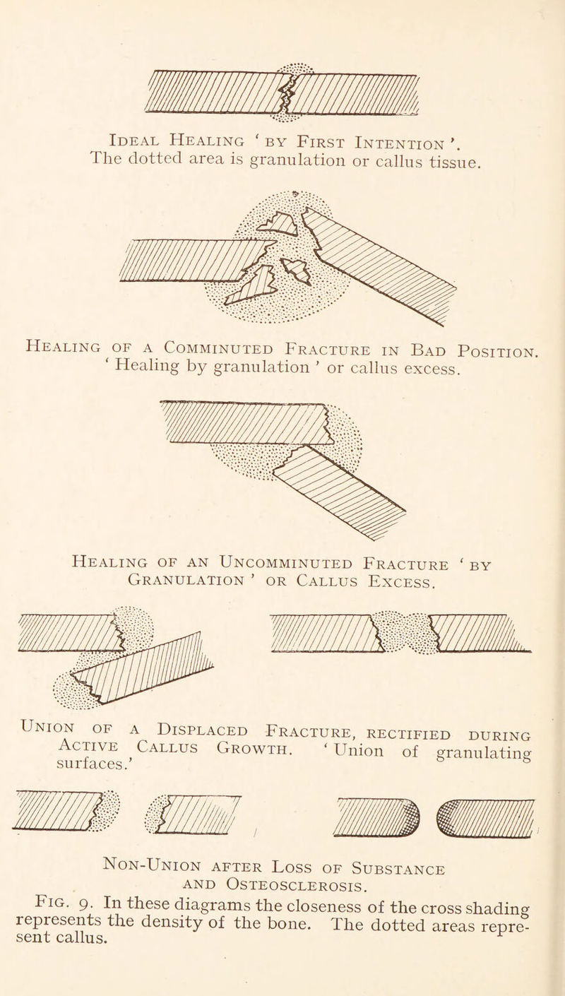 Ideal Healing ‘ by First Intention \ The dotted area is granulation or callus tissue. Healing of a Comminuted Fracture in Bad Position. ' Healing by granulation ’ or callus excess. Healing of an Uncomminuted Fracture ‘ by Granulation ’ or Callus Excess. Union of a Displaced Fracture, rectified during Active Callus Growth. ‘ Union of granulating surfaces.’ ® Non-Union after Loss of Substance and Osteosclerosis. Fig. 9. In these diagrams the closeness of the cross shading represents the density of the bone. The dotted areas repre¬ sent callus.