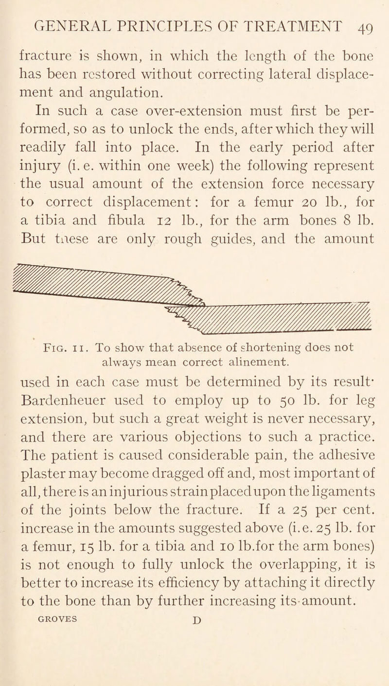 fracture is shown, in which the length of the bone has been restored without correcting lateral displace¬ ment and angulation. In such a case over-extension must first be per¬ formed, so as to unlock the ends, after which they will readily fall into place. In the early period after injury (i.e. within one week) the following represent the usual amount of the extension force necessary to correct displacement: for a femur 20 lb., for a tibia and fibula 12 lb., for the arm bones 8 lb. But taese are only rough guides, and the amount Fig. 11. To show that absence of shortening does not always mean correct alinement. used in each case must be determined by its result* Bardenheuer used to employ up to 50 lb. for leg extension, but such a great weight is never necessary, and there are various objections to such a practice. The patient is caused considerable pain, the adhesive plaster may become dragged off and, most important of all, there is an injurious strain placed upon the ligaments of the joints below the fracture. If a 25 per cent, increase in the amounts suggested above (i.e. 25 lb. for a femur, 15 lb. for a tibia and 10 lb.for the arm bones) is not enough to fully unlock the overlapping, it is better to increase its efficiency by attaching it directly to the bone than by further increasing its-amount. D GROVES