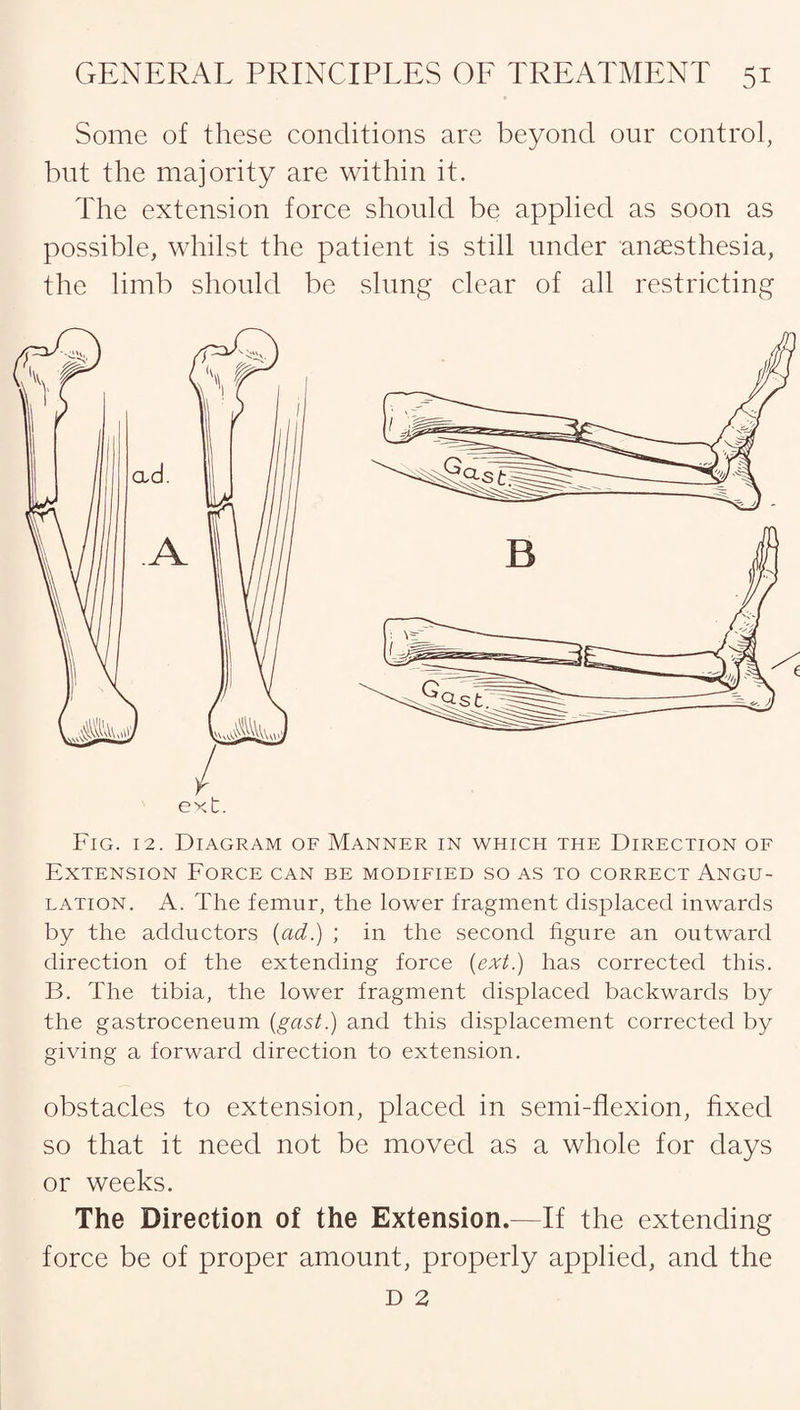 Some of these conditions are beyond our control, but the majority are within it. The extension force should be applied as soon as possible, whilst the patient is still under anaesthesia, the limb should be slung clear of all restricting ext. Fig. 12. Diagram of Manner in which the Direction of Extension Force can be modified so as to correct Angu¬ lation. A. The femur, the lower fragment displaced inwards by the adductors (ad.) ; in the second figure an outward direction of the extending force (ext.) has corrected this. B. The tibia, the lower fragment displaced backwards by the gastroceneum (gast.) and this displacement corrected by giving a forward direction to extension. obstacles to extension, placed in semi-flexion, fixed so that it need not be moved as a whole for days or weeks. The Direction of the Extension.—If the extending force be of proper amount, properly applied, and the D 2
