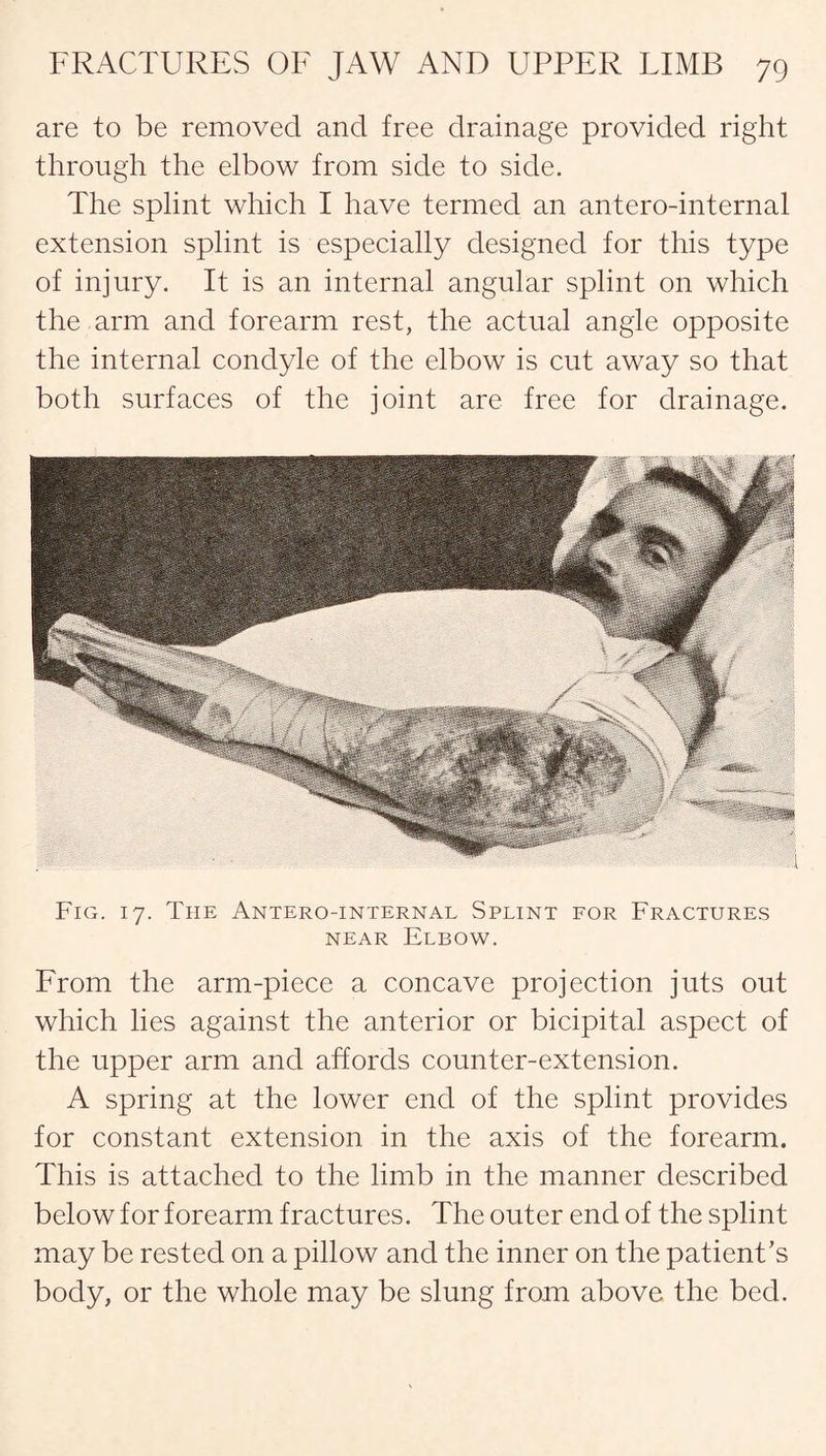 are to be removed and free drainage provided right through the elbow from side to side. The splint which I have termed an antero-internal extension splint is especially designed for this type of injury. It is an internal angular splint on which the arm and forearm rest, the actual angle opposite the internal condyle of the elbow is cut away so that both surfaces of the joint are free for drainage. Fig. 17. The Antero-internal Splint for Fractures near Elbow. From the arm-piece a concave projection juts out which lies against the anterior or bicipital aspect of the upper arm and affords counter-extension. A spring at the lower end of the splint provides for constant extension in the axis of the forearm. This is attached to the limb in the manner described below for forearm fractures. The outer end of the splint may be rested on a pillow and the inner on the patient’s body, or the whole may be slung from above the bed.