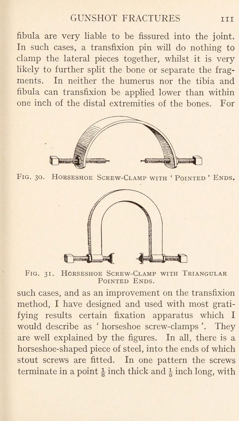 fibula are very liable to be fissured into the joint. In such cases, a transfixion pin will do nothing to clamp the lateral pieces together, whilst it is very likely to further split the bone or separate the frag¬ ments. In neither the humerus nor the tibia and fibula can transfixion be applied lower than within one inch of the distal extremities of the bones. For Fig. 30. Horseshoe Screw-Clamp with ‘ Pointed ’ Ends. Fig. 31. Horseshoe Screw-Clamp with Triangular Pointed Ends. such cases, and as an improvement on the transfixion method, I have designed and used with most grati¬ fying results certain fixation apparatus which I would describe as ‘ horseshoe screw-clamps \ They are well explained by the figures. In all, there is a horseshoe-shaped piece of steel, into the ends of which stout screws are fitted. In one pattern the screws terminate in a point inch thick and J inch long, with