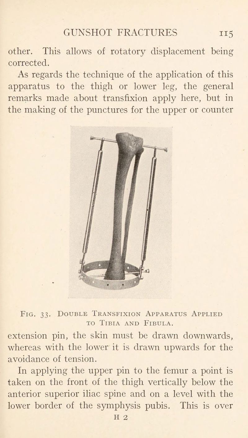 other. This allows of rotatory displacement being corrected. As regards the technique of the application of this apparatus to the thigh or lower leg, the general remarks made about transfixion apply here, but in the making of the punctures for the upper or counter Fig. 33. Double Transfixion Apparatus Applied to Tibia and Fibula. extension pin, the skin must be drawn downwards, whereas with the lower it is drawn upwards for the avoidance of tension. In applying the upper pin to the femur a point is taken on the front of the thigh vertically below the anterior superior iliac spine and on a level with the lower border of the symphysis pubis. This is over h 2