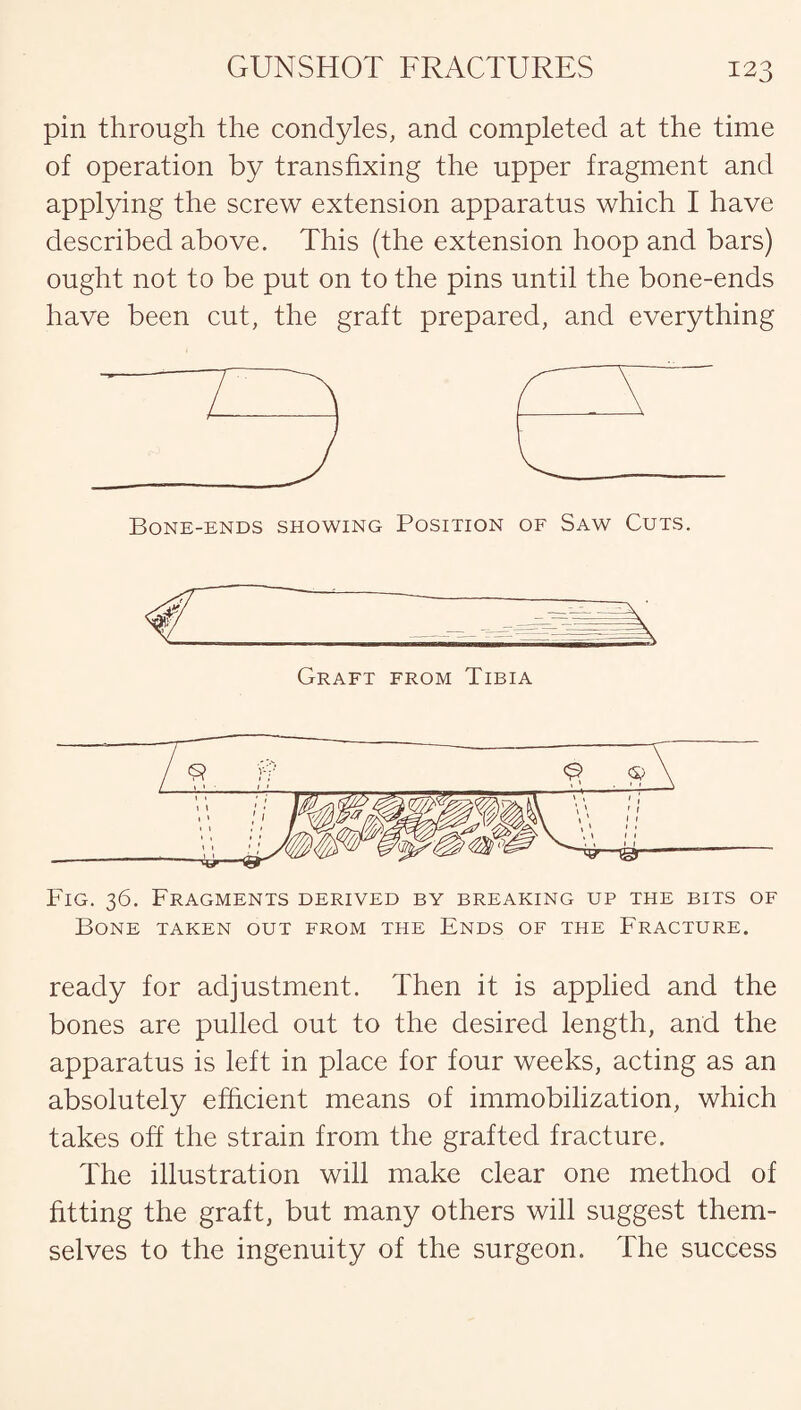 pin through the condyles, and completed at the time of operation by transfixing the upper fragment and applying the screw extension apparatus which I have described above. This (the extension hoop and bars) ought not to be put on to the pins until the bone-ends have been cut, the graft prepared, and everything Bone-ends showing Position of Saw Cuts. Graft from Tibia Fig. 36. Fragments derived by breaking up the bits of Bone taken out from the Ends of the Fracture. ready for adjustment. Then it is applied and the bones are pulled out to the desired length, and the apparatus is left in place for four weeks, acting as an absolutely efficient means of immobilization, which takes off the strain from the grafted fracture. The illustration will make clear one method of fitting the graft, but many others will suggest them¬ selves to the ingenuity of the surgeon. The success