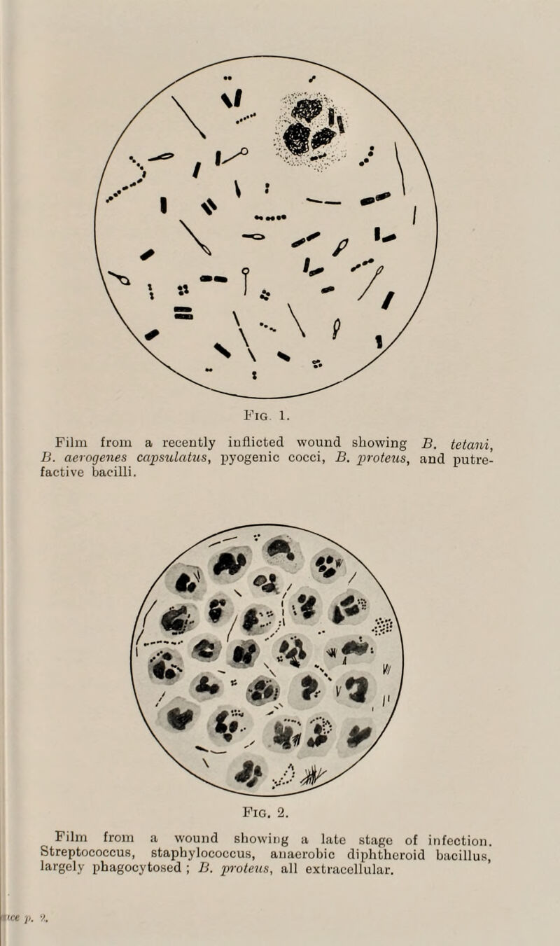 Film from a recently inflicted wound showing B. tetani, B. aerogenes capsulatus, pyogenic cocci, B. proteus, and putre¬ factive bacilli. Fig. 2. Film from a wound showing a late stage of infection. Streptococcus, staphylococcus, anaerobic diphtheroid bacillus, largely phagocytosed ; B. proteus, all extracellular.