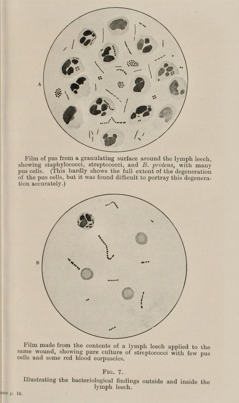 Film of pus from a granulating surface around the lymph leech, showing staphylococci, streptococci, and B. proteus, with many pus cells. (This hardly shows the full extent of the degeneration of the pus cells, but it was found difficult to portray this degenera¬ tion accurately.) Film made from the contents of a lymph leech applied to the same wound, showing pure culture of streptococci with few pus cells and some red blood corpuscles. Fig. 7. Illustrating the bacteriological findings outside and inside the lymph leech. *<« 16.