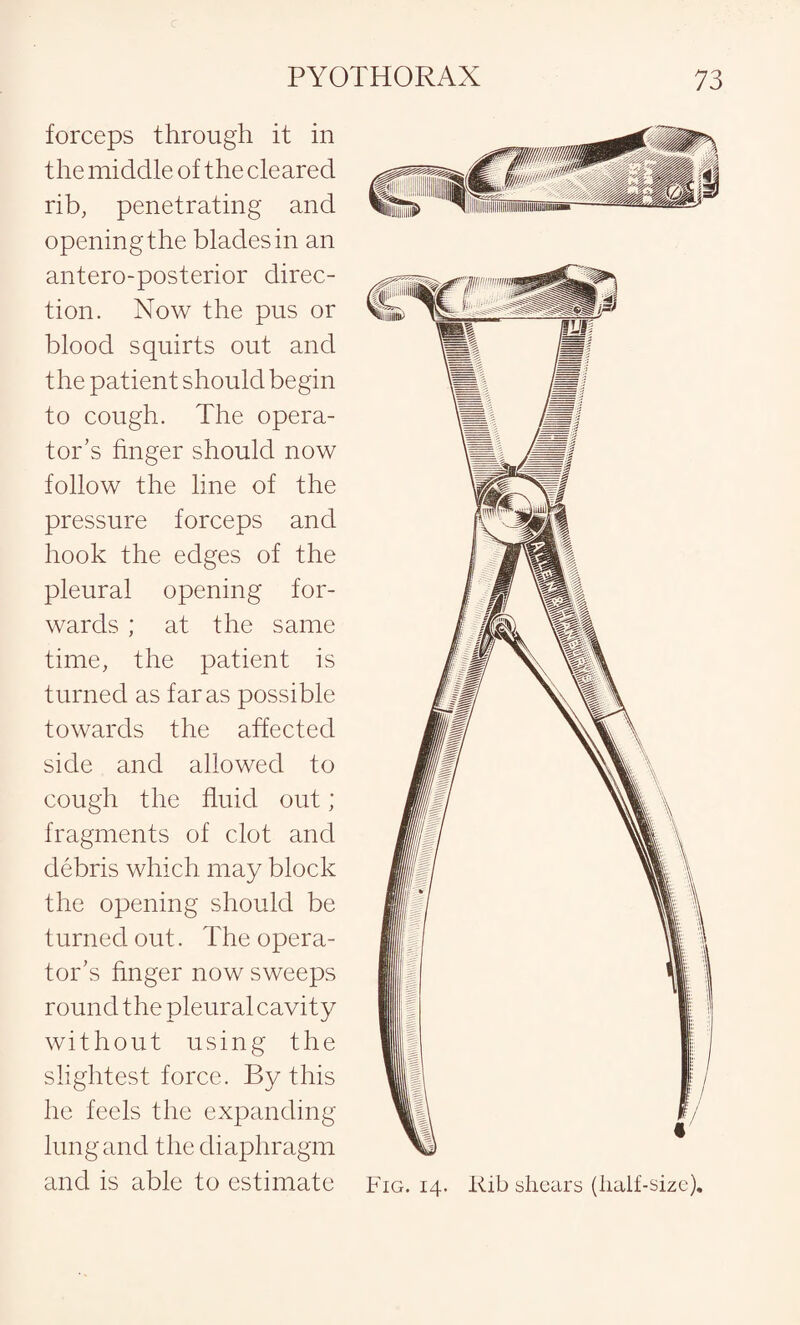 forceps through it in the middle of the cleared rib, penetrating and opening the blades in an antero-posterior direc¬ tion. Now the pus or blood squirts out and the patient should begin to cough. The opera¬ tor’s finger should now follow the line of the pressure forceps and hook the edges of the pleural opening for¬ wards ; at the same time, the patient is turned as far as possible towards the affected side and allowed to cough the fluid out; fragments of clot and debris which may block the opening should be turned out. The opera¬ tor’s finger now sweeps round the pleural cavity without using the slightest force. By this he feels the expanding lung and the diaphragm and is able to estimate Fig. 14. Rib shears (half-size).