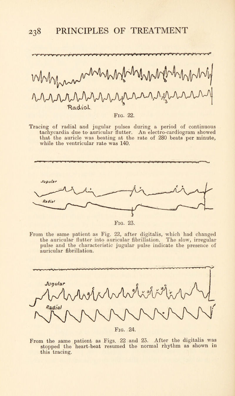 AAAAAAAMW 'Radial Fig. 22. Tracing of radial and jugular pulses during a period of continuous tachycardia due to auricular flutter. An electro-cardiogram showed that the auricle was beating at the rate of 280 beats per minute, while the ventricular rate was 140. xpsa&ssi&sH&a From the same patient as Fig. 22, after digitalis, which had changed the auricular flutter into auricular fibrillation. The slow, irregular pulse and the characteristic jugular pulse indicate the presence of auricular fibrillation. From the same patient as Figs. 22 and 23. After the digitalis was stopped the heart-beat resumed the normal rhythm as shown in this tracing.