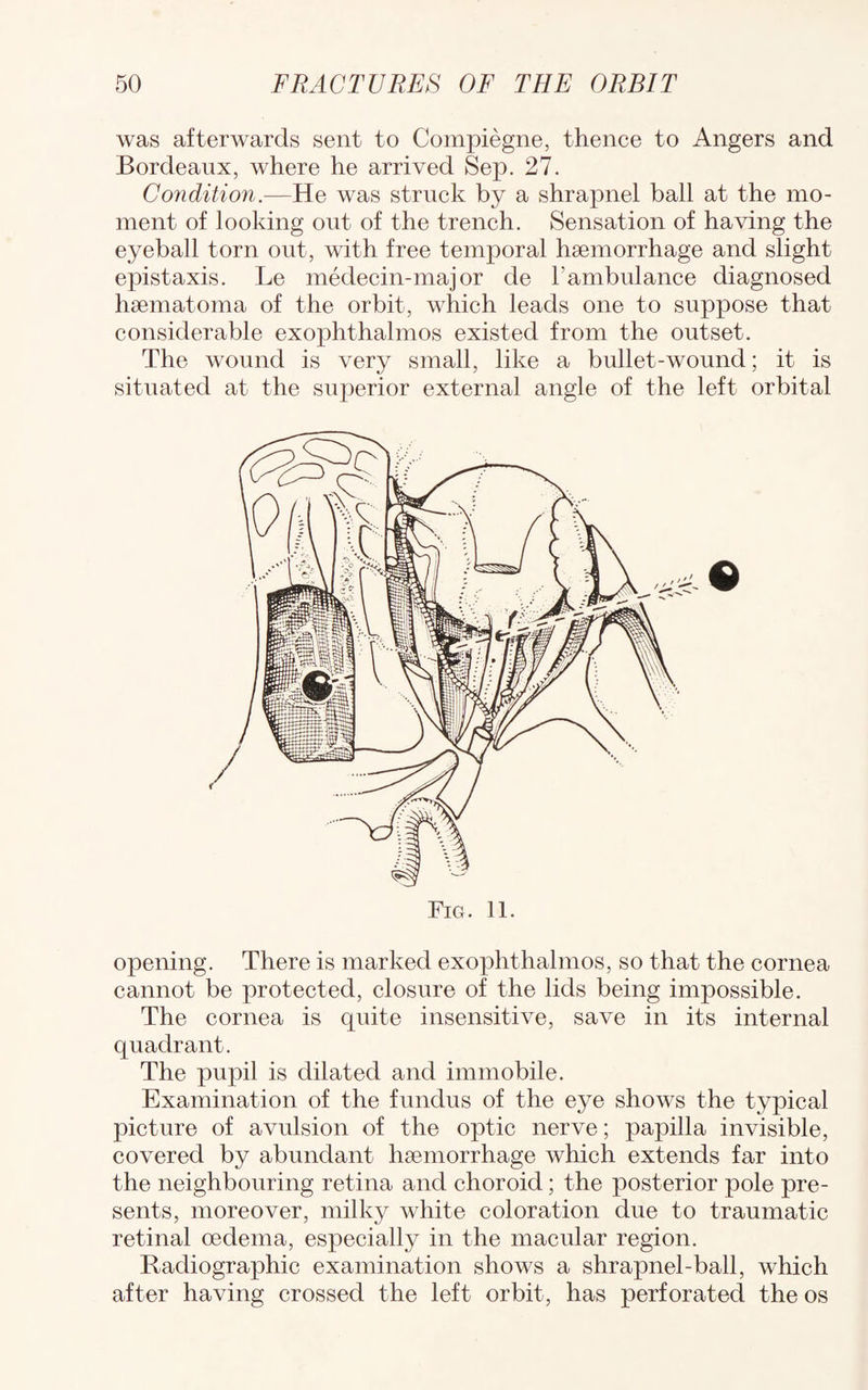 was afterwards sent to Compiegne, thence to Angers and Bordeaux, where he arrived Sep. 27. Condition.—He was struck by a shrapnel ball at the mo¬ ment of looking out of the trench. Sensation of having the eyeball torn out, with free temporal haemorrhage and slight epistaxis. Le medecin-major de F ambulance diagnosed hsematoma of the orbit, which leads one to suppose that considerable exophthalmos existed from the outset. The wound is very small, like a bullet-wound; it is situated at the superior external angle of the left orbital Fig. 11. opening. There is marked exophthalmos, so that the cornea cannot be protected, closure of the lids being impossible. The cornea is quite insensitive, save in its internal quadrant. The pupil is dilated and immobile. Examination of the fundus of the eye shows the typical picture of avulsion of the optic nerve; papilla invisible, covered by abundant haemorrhage which extends far into the neighbouring retina and choroid; the posterior pole pre¬ sents, moreover, milky white coloration due to traumatic retinal oedema, especially in the macular region. Radiographic examination shows a shrapnel-ball, which after having crossed the left orbit, has perforated the os