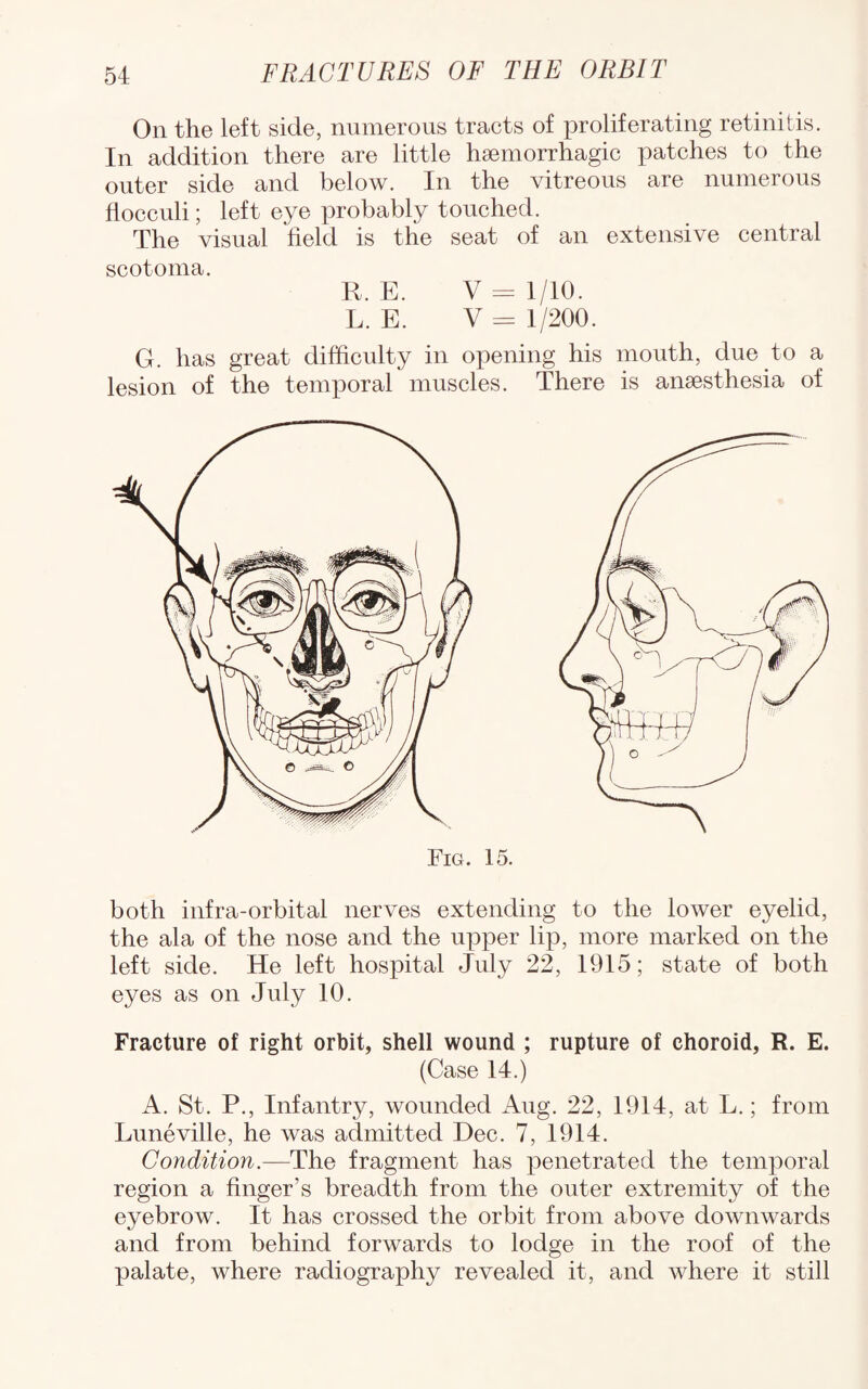 On the left side, numerous tracts of proliferating retinitis. In addition there are little haemorrhagic patches to the outer side and below. In the vitreous are numerous flocculi; left eye probably touched. The visual field is the seat of an extensive central scotoma. R. E. V = 1/10. L. E. V= 1/200. G. has great difficulty in opening his mouth, due to a lesion of the temporal muscles. There is anaesthesia of Fig. 15. both infra-orbital nerves extending to the lower eyelid, the ala of the nose and the upper lip, more marked on the left side. He left hospital July 22, 1915; state of both eyes as on July 10. Fracture of right orbit, shell wound ; rupture of choroid, R. E. (Case 14.) A. St. P., Infantry, wounded Aug. 22, 1914, at L.; from Luneville, he was admitted Dec. 7, 1914. Condition.—The fragment has penetrated the temporal region a finger’s breadth from the outer extremity of the eyebrow. It has crossed the orbit from above downwards and from behind forwards to lodge in the roof of the palate, where radiography revealed it, and where it still