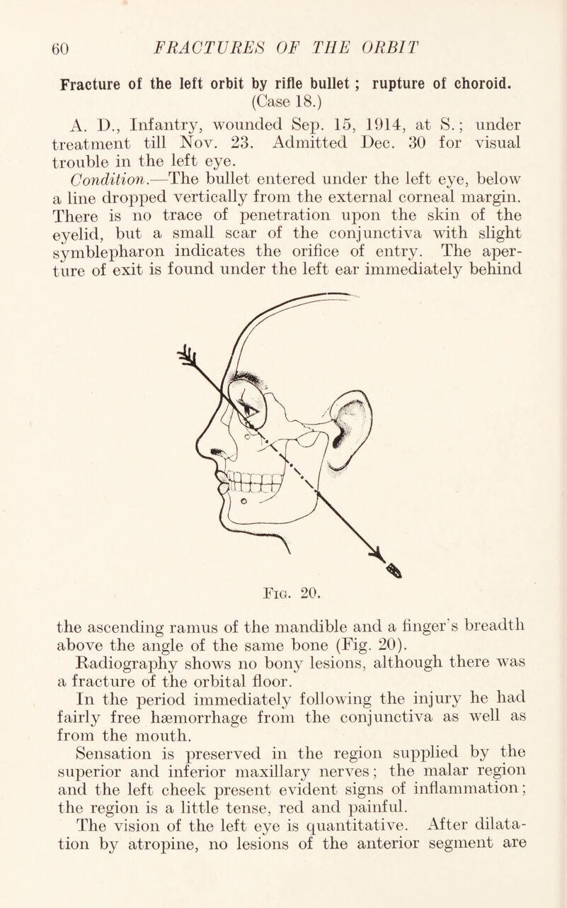 Fracture of the left orbit by rifle bullet; rupture of choroid. (Case 18.) A. D., Infantry, wounded Sep. 15, 1914, at S.; under treatment till Nov. 23. Admitted Dec. 30 for visual trouble in the left eye. Conditio7i.—The bullet entered under the left eye, below a line dropped vertically from the external corneal margin. There is no trace of penetration upon the skin of the eyelid, but a small scar of the conjunctiva with slight symblepharon indicates the orifice of entry. The aper¬ ture of exit is found under the left ear immediately behind the ascending ramus of the mandible and a finger s breadth above the angle of the same bone (Fig. 20). Radiography shows no bony lesions, although there was a fracture of the orbital floor. In the period immediately following the injury he had fairly free haemorrhage from the conjunctiva as well as from the mouth. Sensation is preserved in the region supplied by the superior and inferior maxillary nerves; the malar region and the left cheek present evident signs of inflammation; the region is a little tense, red and painful. The vision of the left eye is quantitative. After dilata¬ tion by atropine, no lesions of the anterior segment are