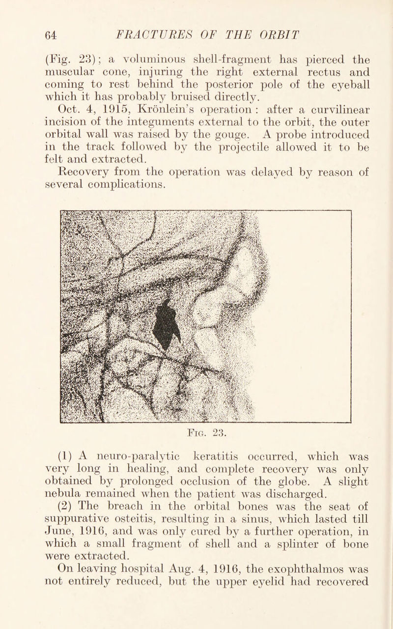 (Fig. 23); a voluminous shell-fragment has pierced the muscular cone, injuring the right external rectus and coming to rest behind the posterior pole of the eyeball which it has probably bruised directly. Oct. 4, 1915, Kronlein's operation : after a curvilinear incision of the integuments external to the orbit, the outer orbital wall was raised by the gouge. A probe introduced in the track followed by the projectile allowed it to be felt and extracted. Recovery from the operation was delayed by reason of several complications. Fig. 23. (1) A neuro-paralytic keratitis occurred, which was very long in healing, and complete recovery was only obtained by prolonged occlusion of the globe. A slight nebula remained when the patient was discharged. (2) The breach in the orbital bones was the seat of suppurative osteitis, resulting in a sinus, which lasted till June, 1916, and was only cured by a further operation, in which a small fragment of shell and a splinter of bone were extracted. On leaving hospital Aug. 4, 1916, the exophthalmos was not entirely reduced, but the upper eyelid had recovered