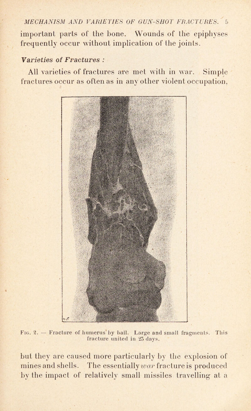 important parts of the bone. Wounds of the epiphyses frequently occur without implication of the joints. Varieties of Fractures : All varieties of fractures are met with in war. Simple fractures occur as often as in any other violent occupation, Fig. 2. — Fracture of humerus'by ball. Large and small fragments. This fracture united in 25 days. but they are caused more particularly by the explosion of mines and shells. The essentially war fracture is produced by the impact of relatively small missiles travelling at a