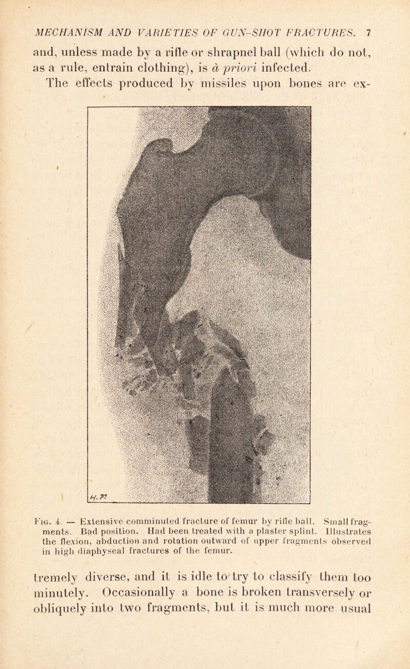 and, unless made by a rifle or shrapnel ball (which do not, as a rule, entrain clothing), is a priori infected. The effects produced by missiles upon bones are ex- FiG. 4. — Extensive comminuted fracture of femur by rifle ball. Small frag¬ ments. Bad position. Had been treated with a plaster splint. Illustrates the flexion, abduction and rotation outward of upper fragments observed in high diaphyseal fractures of the femur. tremely diverse, and it is idle to try to classify them too minutely. Occasionally a bone is broken transversely or obliquely into two fragments, but it is much more usual