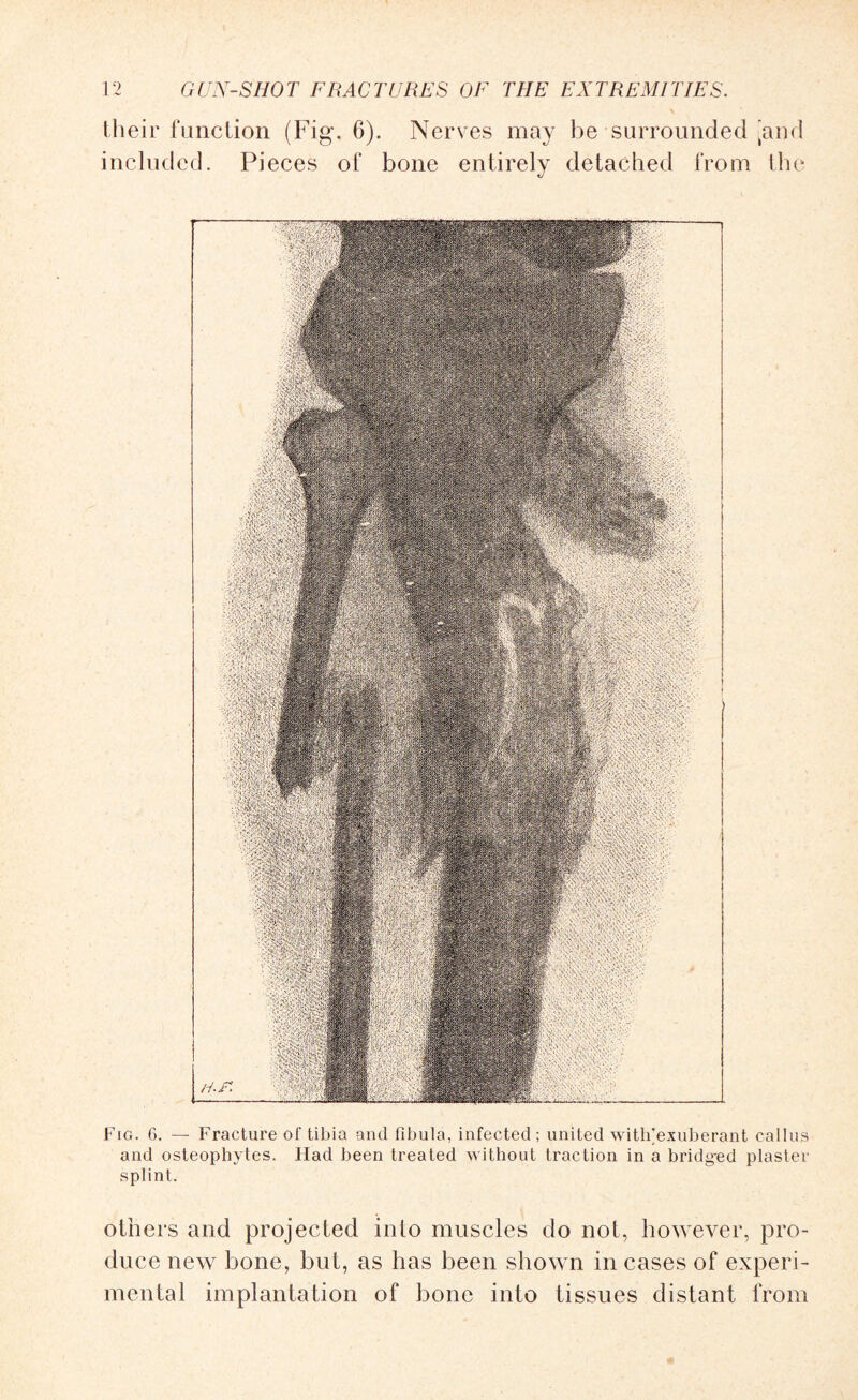 their function (Fig. 6). Nerves may be surrounded ’and included. Pieces of bone entirely detached from the Fig. 6. — Fracture of tibia and fibula, infected; united witlrexuberant callus and osteophytes. Had been treated without traction in a bridged plaster splint. others and projected into muscles do not, however, pro¬ duce new bone, but, as has been shown in cases of experi¬ mental implantation of bone into tissues distant from