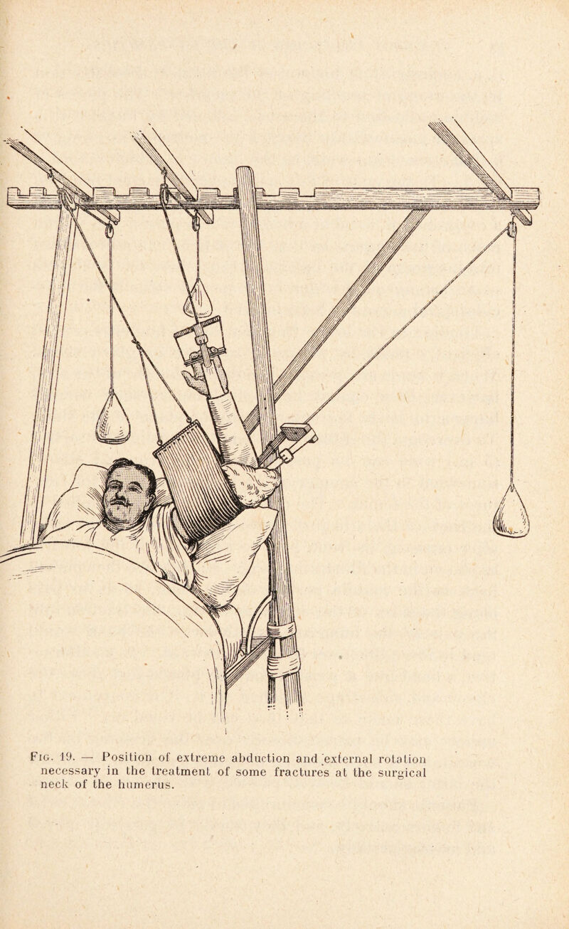 Fig. 19. —- Position of extreme abduction and external rotation necessary in the treatment of some fractures at the surgical neck of the humerus.