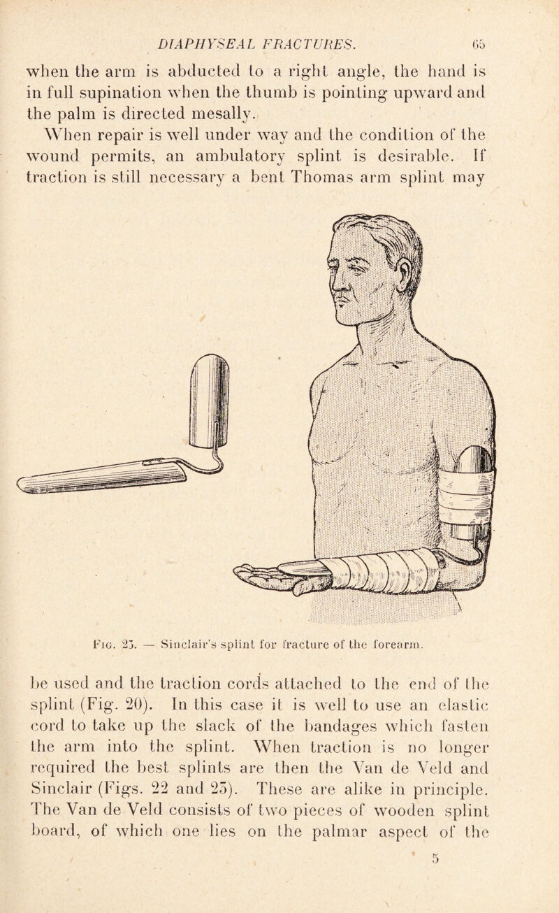 when the arm is abducted to a right angle, the hand is in full supination when the thumb is pointing upward and the palm is directed mesally. When repair is well under way and the condition of the wound permits, an ambulatory splint is desirable. If traction is still necessary a bent Thomas arm splint may Fig. 23. — Sinclair’s splint for fracture of the forearm. be used and the traction cords attached to the end of the splint (Fig. 20). In this case it is well to use an elastic cord to take up the slack of the bandages which fasten the arm into the splint. When traction is no longer required the best splints are then the Van de Veld and Sinclair (Figs. 22 and 25). These are alike in principle. The Van de Veld consists of two pieces of wooden splint board, of which one lies on the palmar aspect of the