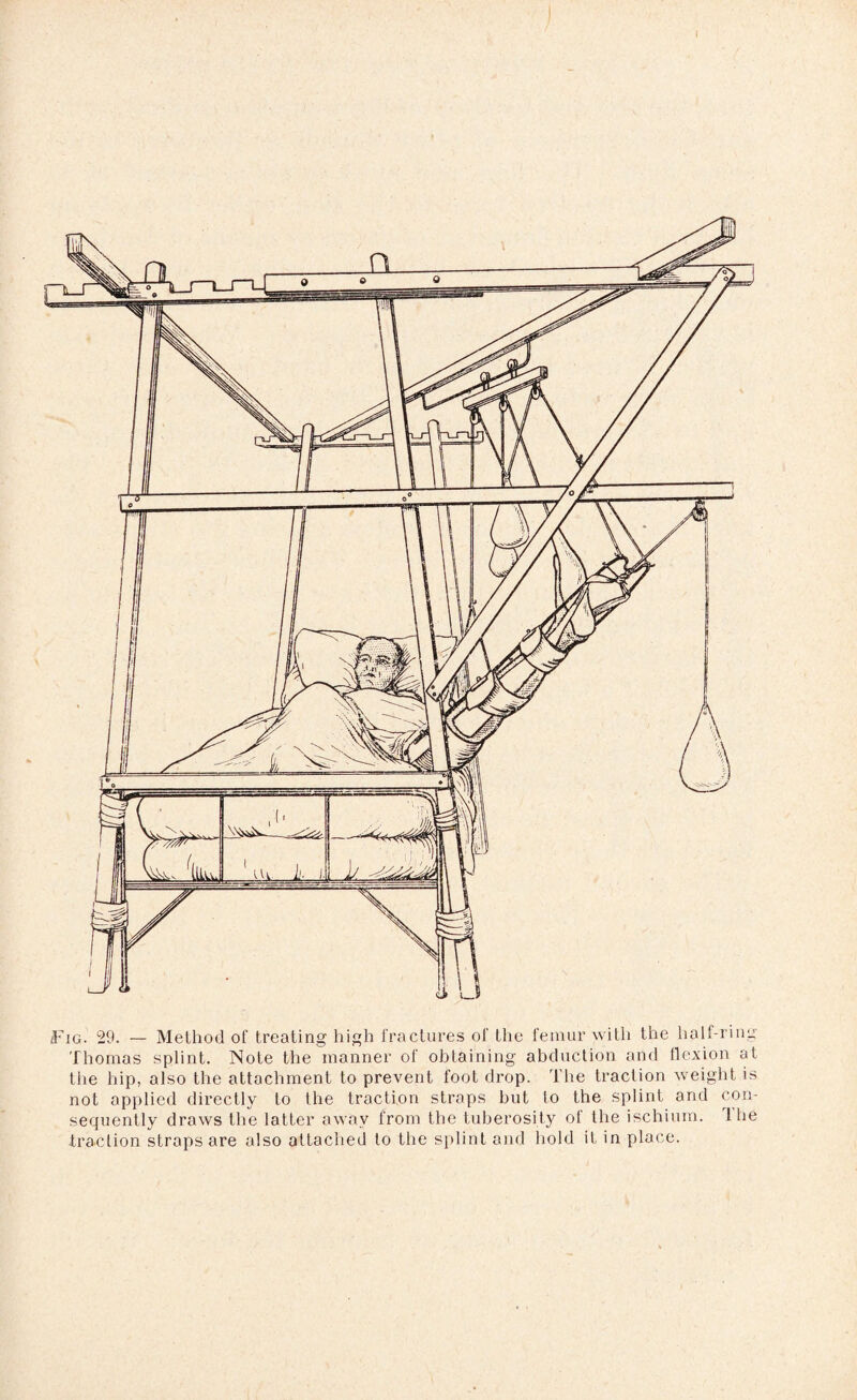 Fig. 29. — Method of treating high fractures of the femur with the half-ring Thomas splint. Note the manner of obtaining abduction and flexion at the hip, also the attachment to prevent foot drop. The traction weight is not applied directly to the traction straps but to the splint and con¬ sequently draws the latter away from the tuberosity ol the ischium, lhe traclion straps are also attached to the splint and hold it in place.