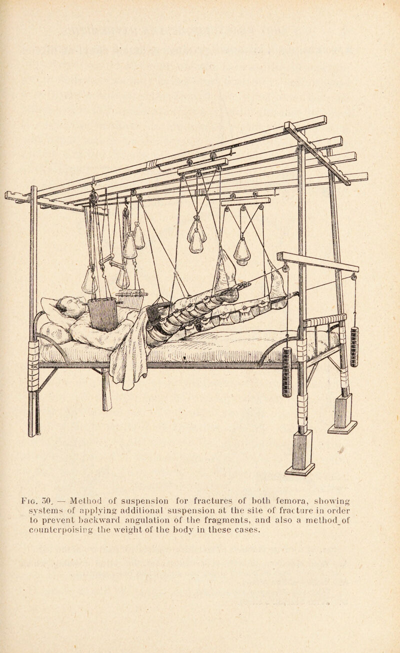 Fig. 50v — Method of suspension for fractures of both femora, showing systems of applying addilional suspension at the site of fracture in order to prevent backward angulation of the fragments, and also a methodof counterpoising the weight of the body in these cases.