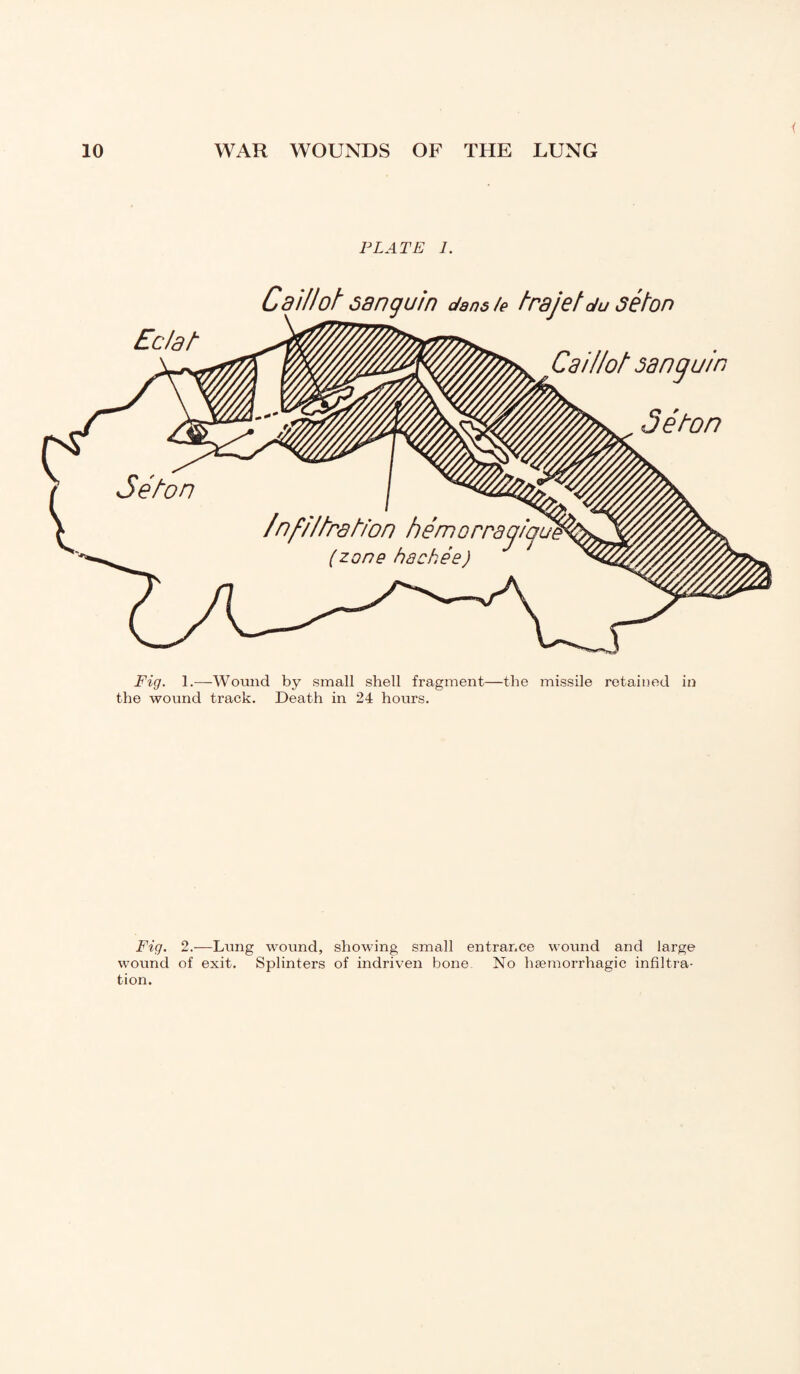 ( PLATE 1. Cd 'lllof sanguin dans/e frajef du séton Caillot sanguin Séton Fig. 1.—Wound by small shell fragment—the missile retained in the wound track. Death in 24 hours. Fig. 2.—Lung wound, showing small entrance wound and large wound of exit. Splinters of indriven bone No haemorrhagic infiltra¬ tion.