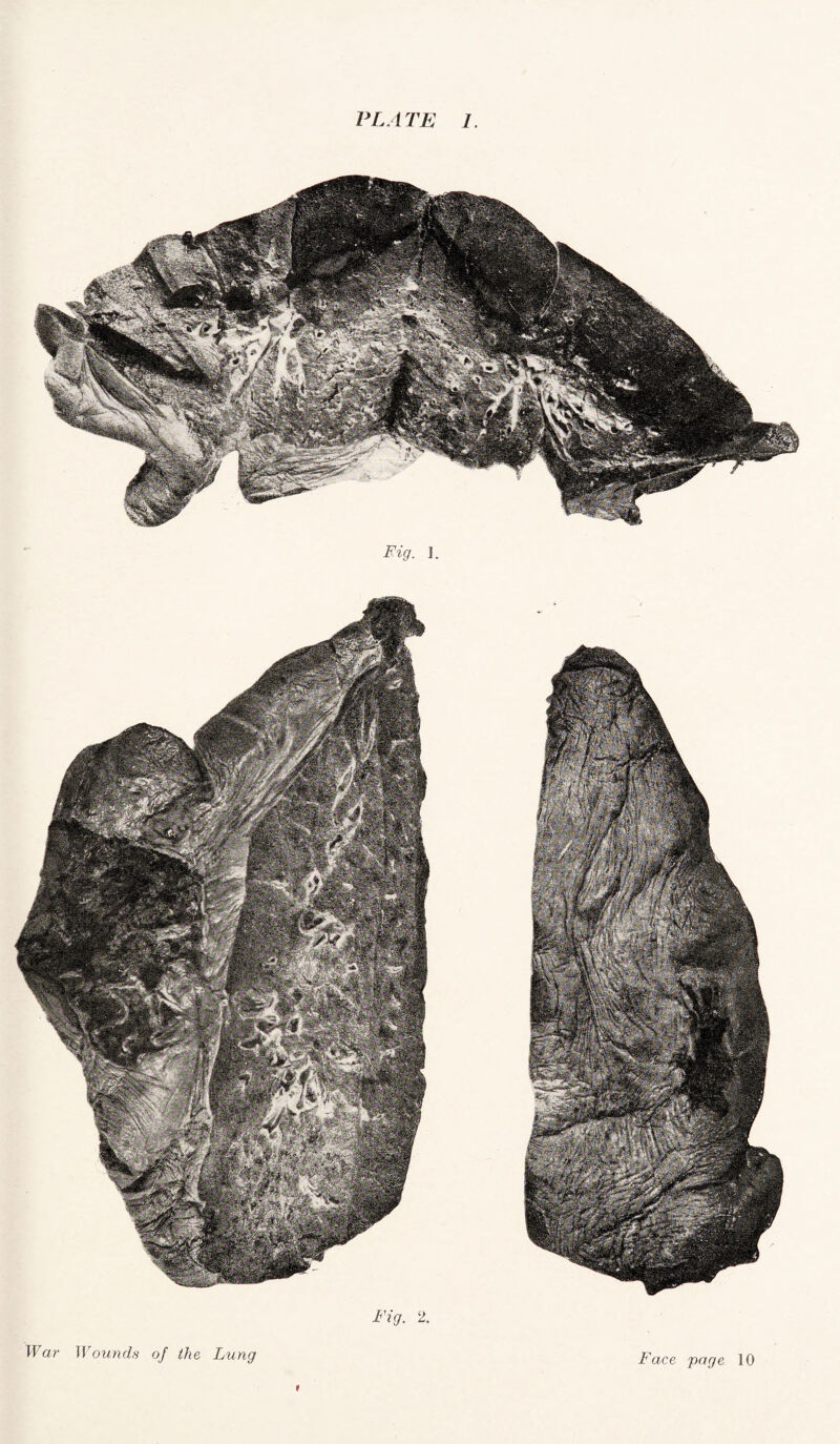 Fig. 2. War Wounds of the Lung t