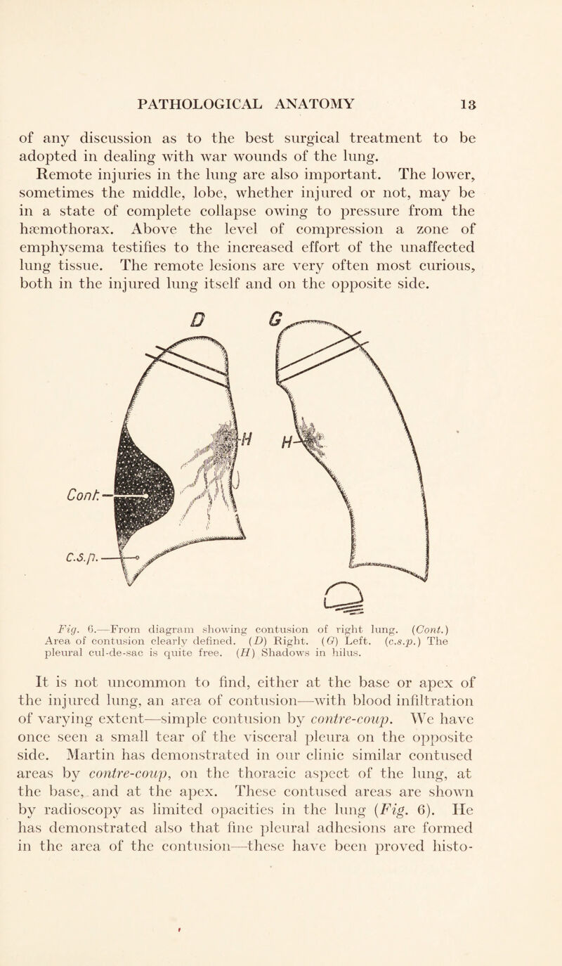 of any discussion as to the best surgical treatment to be adopted in dealing with war wounds of the lung. Remote injuries in the lung are also important. The lower, sometimes the middle, lobe, whether injured or not, may be in a state of complete collapse owing to pressure from the hæmothorax. Above the level of compression a zone of emphysema testifies to the increased effort of the unaffected lung tissue. The remote lesions are very often most curious, both in the injured lung itself and on the opposite side. n n Cont. — c.s.p. Q Fig. G.—From diagram showing contusion of right lung. (Cont.) Area of contusion clearly defined. (D) Right. (G) Left. (c.s.p. ) The pleural cul-de-sac is quite free. (H) Shadows in hilus. It is not uncommon to find, either at the base or apex of the injured lung, an area of contusion—with blood infiltration of varying extent—simple contusion by contre-coup. We have once seen a small tear of the visceral pleura on the opposite side. Martin has demonstrated in our clinic similar contused areas by contre-coup, on the thoracic aspect of the lung, at the base, and at the apex. These contused areas are shown by radioscopy as limited opacities in the lung (Fig. 6). He has demonstrated also that fine pleural adhesions are formed in the area of the contusion—these have been proved histo-