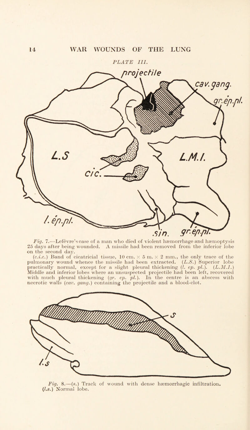 PLATE III. Fig. 7.—Lefèvre’s case of a man who died of violent haemorrhage and haemoptysis 25 days after being wounded. A missile had been removed from the inferior lobe on the second day. (c.i.c.) Band of cicatricial tissue, 10 cm. x 5 m. x 2 mm., the only trace of the pulmonary wound whence the missile had been extracted. (L.S.) Superior lobe practically normal, except for a slight pleural thickening (l. ep. pi.). (L.M.l.) Middle and inferior lobes where an unsuspected projectile had been left, recovered with much pleural thickening (gr. ep. pi.). In the centre is an abscess with necrotic walls (car. gang.) containing the projectile and a blood-clot. Fig. 8.—(s.) Track of wound with dense hæmorrhagic infiltration. (l.s.) Normal lobe.