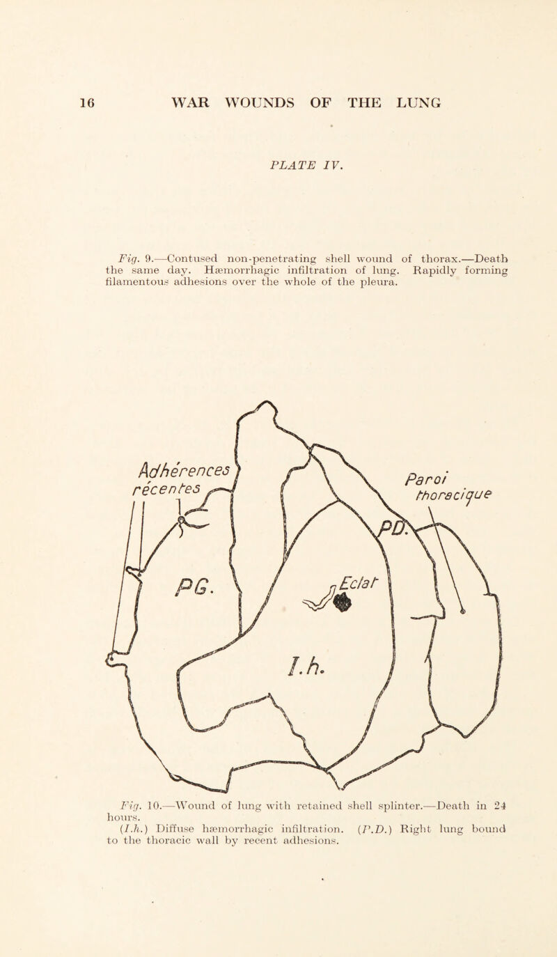PLATE IV. Fig. 9.—Contused non-penetrating shell wound of thorax.—Death the same day. Haemorrhagic infiltration of lung. Rapidly forming filamentous adhesions over the whole of the pleura. Fig. 10.—Wound of lung with retained shell splinter.—Death in 24 hours. (I.h.) Diffuse haemorrhagic infiltration. (P.D.) Right lung bound to the thoracic wall by recent adhesions.