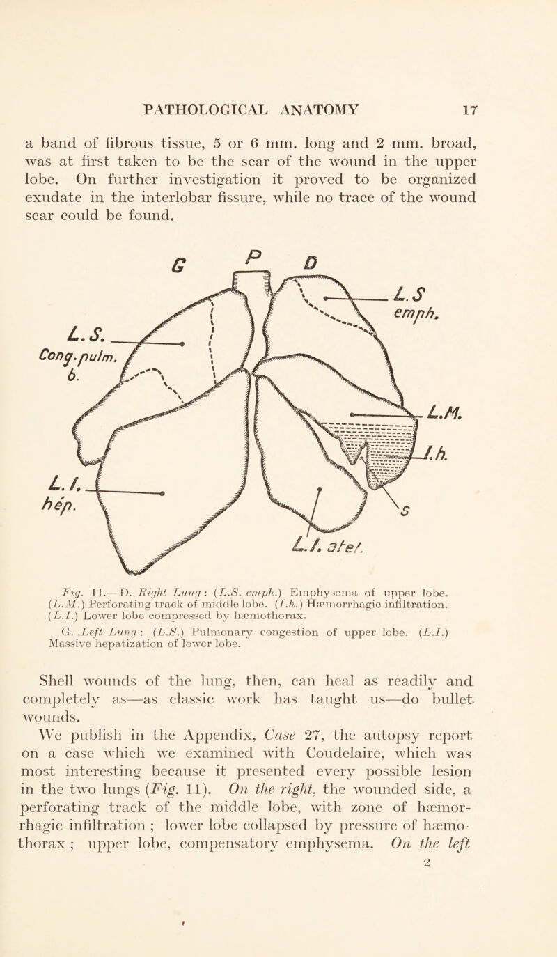 a band of fibrous tissue, 5 or 6 mm. long and 2 mm. broad, was at first taken to be the scar of the wound in the upper lobe. On further investigation it proved to be organized exudate in the interlobar fissure, while no trace of the wound scar could be found. l.m. A a/e/ L.S. Cony, pulm. h. L.S emph. Fig. 11.—D. Right Lung-. (L.S. emph.) Emphysema of upper lobe. (L.M.) Perforating track of middle lobe. (I.h.) Haemorrhagic infiltration. (L.I.) Lower lobe compressed by hæmothorax. G. Left Lung : (L.S.) Pulmonary congestion of upper lobe. (L.I.) Massive hepatization of lower lobe. Shell wounds of the lung, then, can heal as readily and completely as—as classic work has taught us—do bullet wounds. We publish in the Appendix, Case 27, the autopsy report on a case which we examined with Coudelaire, which was most interesting because it presented every possible lesion in the two lungs (Fig. 11). On the right, the wounded side, a perforating track of the middle lobe, with zone of haemor¬ rhagic infiltration ; lower lobe collapsed by pressure of hæmo¬ thorax ; upper lobe, compensatory emphysema. On the left 2