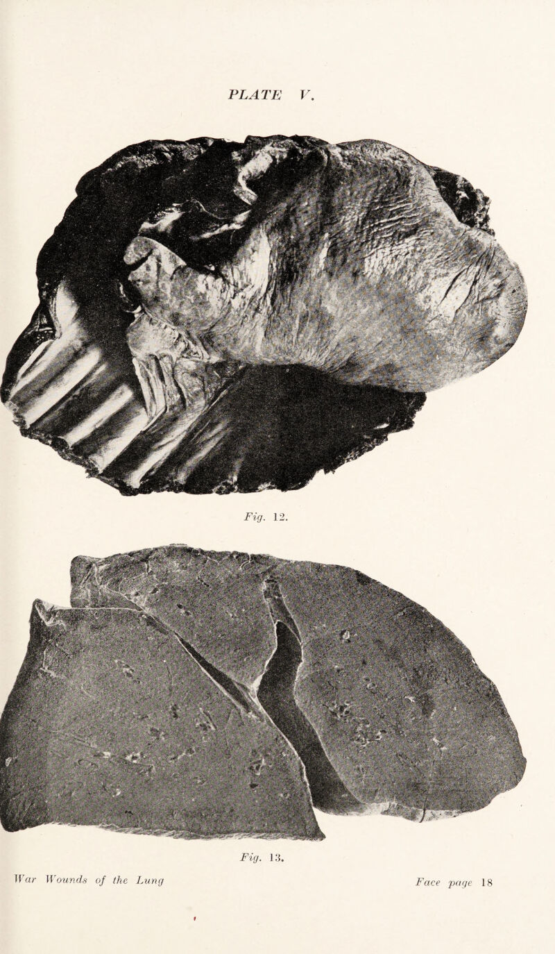 Fig. 12. Fig. 13. War Wounds of the Lung Face page 18 9