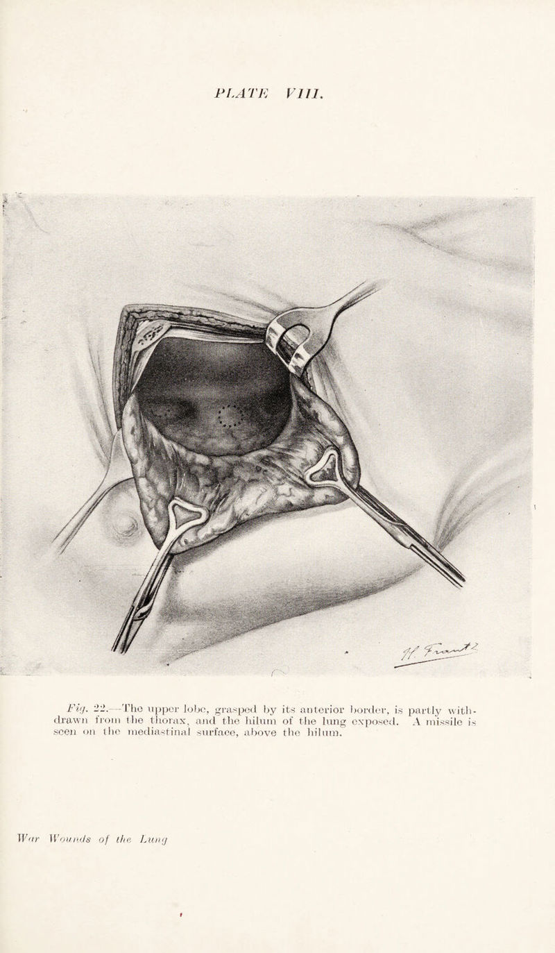 Fig. 22.—The upper lobe, grasped by its anterior drawn from the thorax, and the hilum of the lung seen on the mediastinal surface, above the hilum. border, is exposed. partly with- A missile is War Wounds of the Lung
