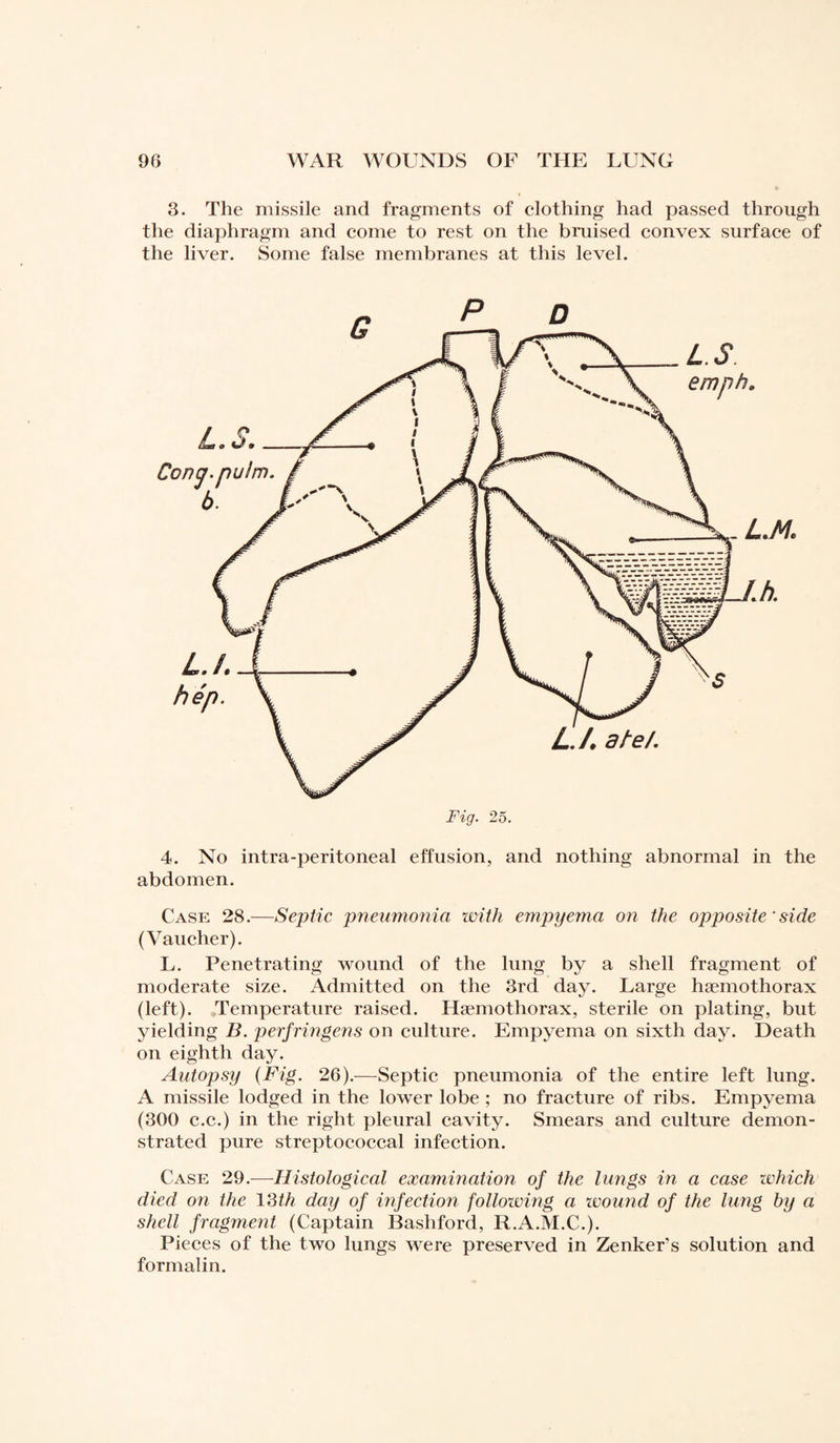 3. The missile and fragments of clothing had passed through the diaphragm and come to rest on the bruised convex surface of the liver. Some false membranes at this level. 4. No intra-peritoneal effusion, and nothing abnormal in the abdomen. Case 28.—Septic pneumonia with empyema on the opposite'side (Vaucher). L. Penetrating wound of the lung by a shell fragment of moderate size. Admitted on the 3rd day. Large hæmothorax (left). Temperature raised. Hæmothorax, sterile on plating, but yielding B. perfringens on culture. Empyema on sixth day. Death on eighth day. Autopsy (Fig. 26).—Septic pneumonia of the entire left lung. A missile lodged in the lower lobe ; no fracture of ribs. Empyema (300 c.c.) in the right pleural cavity. Smears and culture demon¬ strated pure streptococcal infection. Case 29.—Histological examination of the lungs in a case which died on the 13th day of infection following a wound of the lung by a shell fragment (Captain Bashford, R.A.M.C.). Pieces of the two lungs wrere preserved in Zenker’s solution and formalin.