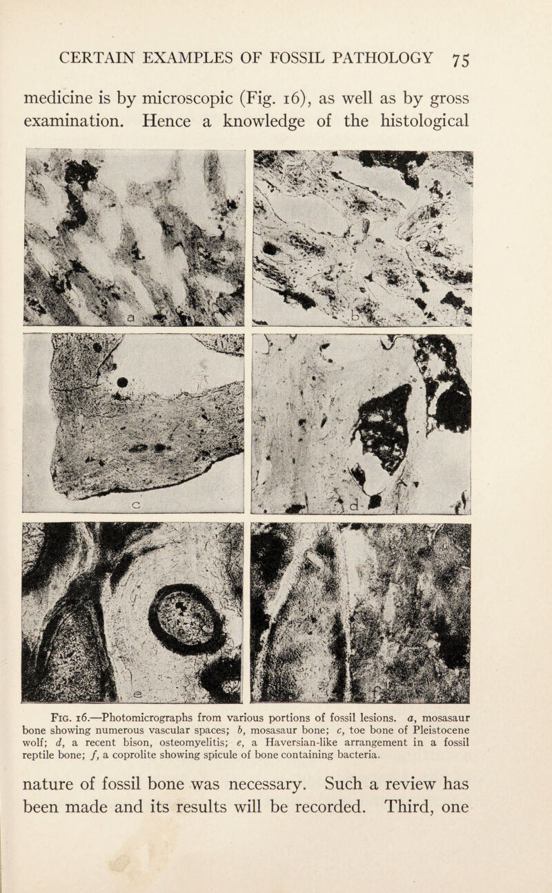 medicine is by microscopic (Fig. 16), as well as by gross examination. Hence a knowledge of the histological Fig. 16.—Photomicrographs from various portions of fossil lesions, a, mosasaur bone showing numerous vascular spaces; b, mosasaur bone; c, toe bone of Pleistocene wolf; d, a recent bison, osteomyelitis; e, a Haversian-like arrangement in a fossil reptile bone; /, a coprolite showing spicule of bone containing bacteria. nature of fossil bone was necessary. Such a review has been made and its results will be recorded. Third, one