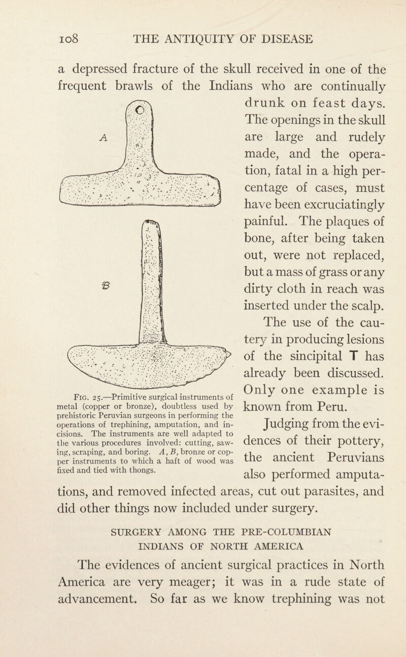 a depressed fracture of the skull received in one of the frequent brawls of the Indians who are continually drunk on feast days. The openings in the skull are large and rudely made, and the opera¬ tion, fatal in a high per¬ centage of cases, must have been excruciatingly painful. The plaques of bone, after being taken out, were not replaced, but a mass of grass or any dirty cloth in reach was inserted under the scalp. The use of the cau¬ tery in producing lesions of the sincipital T has already been discussed. Only one example is known from Peru. Judging from the evi¬ dences of their pottery, the ancient Peruvians also performed amputa¬ tions, and removed infected areas, cut out parasites, and did other things now included under surgery. Fig. 25.—Primitive surgical instruments of metal (copper or bronze), doubtless used by prehistoric Peruvian surgeons in performing the operations of trephining, amputation, and in¬ cisions. The instruments are well adapted to the various procedures involved: cutting, saw¬ ing, scraping, and boring. A, B, bronze or cop¬ per instruments to which a haft of wood was fixed and tied with thongs. SURGERY AMONG THE PRE-COLUMBIAN INDIANS OF NORTH AMERICA The evidences of ancient surgical practices in North America are very meager; it was in a rude state of advancement. So far as we know trephining was not
