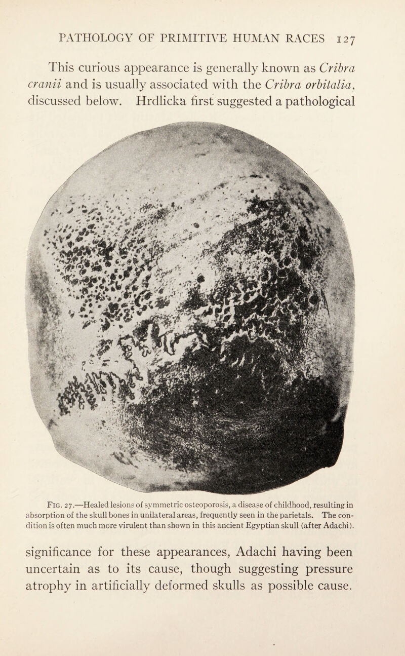 This curious appearance is generally known as Cribra cranii and is usually associated with the Cribra orbitalia, discussed below. Hrdlicka first suggested a pathological Fig. 27.—Healed lesions of symmetric osteoporosis, a disease of childhood, resulting in absorption of the skull bones in unilateral areas, frequently seen in the parietals. The con¬ dition is often much more virulent than shown in this ancient Egyptian skull (after Adachi). significance for these appearances, Adachi having been uncertain as to its cause, though suggesting pressure atrophy in artificially deformed skulls as possible cause.
